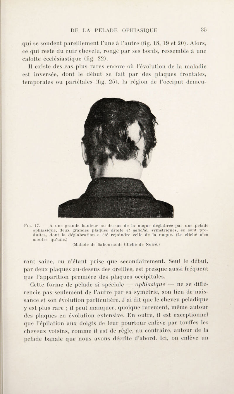 25 qui se soudent pareillement l’une à l’autre (fig. 18, 19 et 20). Alors, ce cjiii reste du cuir chevelu, rongé par ses bords, ressemble à une calotte écclésiastique (fig. 22). II existe des cas plus rares encore où l’évolution de la maladie est inversée, dont le début se fait par des plaques frontales, temporales ou pariétales (fig. 25), la région de l’occiput demeu- Fig. 17. — A une grande hauteur au-dessus de la nuque déglabrée par une pelade ophiasique, deux grandes plaques droite et gauche, symétriques, se sont pro¬ duites, dont la déglabration a été rejoindre celle de la nuque. (Le cliché n’en montre qu’une.) (Malade de Sabouraud. Cliché de Noiré.) rant saine, ou n’étant prise que secondairement. Seul le début, par deux plaques au-dessus des oreilles, est presque aussi fréquent que l’apparition première des plaques occipitales. Cette forme de pelade si spéciale — ophiasique — ne se diffé¬ rencie pas seulement de l’autre par sa symétrie, son lieu de nais¬ sance et son évolution particulière. J’ai dit que le cheveu peladique y est plus rare ; il peut manquer, quoique rarement, même autour des plaques en évolution extensive. En outre, il est exceptionnel que l’épilation aux doigts de leur pourtour enlève par touffes les cheveux voisins, comme il est de règle, au contraire, autour de la pelade banale que nous avons décrite d’abord. Ici, on enlève un