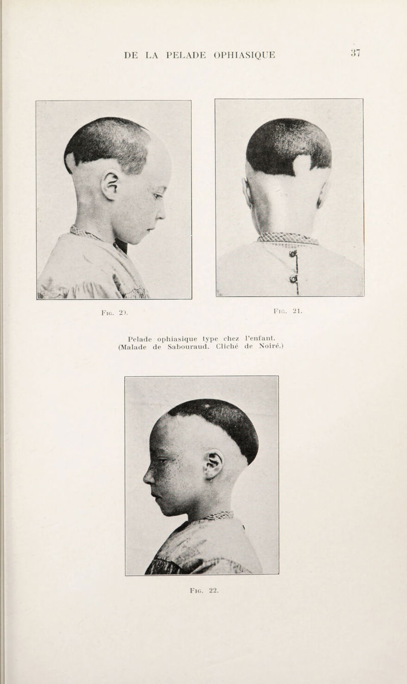 :r IG. 2). Fig. 21. Pelade ophiasique type chez (Malade de Sabouraud. Cliché l’enfant, de Noiré.)