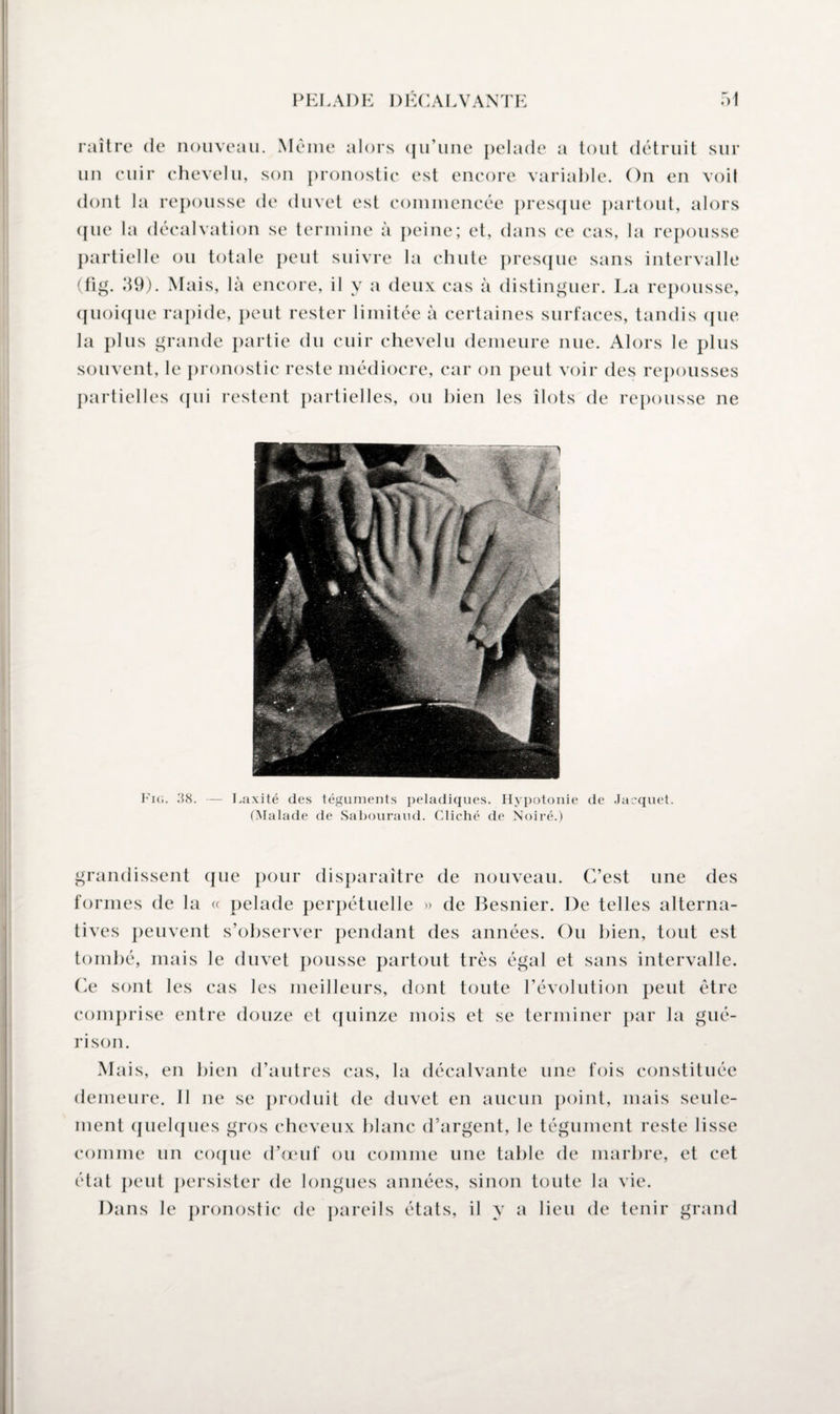 raître de nouveau. Meme alors qu’une pelade a tout détruit sur un cuir chevelu, son pronostic est encore variable. On en voit dont la repousse de duvet est commencée presque partout, alors que la décalvation se termine à peine; et, dans ce cas, la repousse partielle ou totale peut suivre la chute presque sans intervalle (fig. 59). Mais, là encore, il y a deux cas à distinguer. La repousse, quoique rapide, peut rester limitée à certaines surfaces, tandis que la plus grande partie du cuir chevelu demeure nue. Alors le plus souvent, le pronostic reste médiocre, car on peut voir des repousses partielles qui restent partielles, ou bien les îlots de repousse ne Fie. — Laxité des téguments peladiques. Hypotonie de Jacquet. (Malade de Sabouraud. Cliché de Noiré.) grandissent que pour disparaître de nouveau. C’est une des formes de la « pelade perpétuelle » de Besnier. De telles alterna¬ tives peuvent s’observer pendant des années. Ou bien, tout est tombé, mais le duvet pousse partout très égal et sans intervalle. Ce sont les cas les meilleurs, dont toute l’évolution peut être comprise entre douze et quinze mois et se terminer par la gué¬ rison. Mais, en bien d’autres cas, la décalvante une fois constituée demeure. Il ne se produit de duvet en aucun point, mais seule¬ ment quelques gros cheveux blanc d’argent, le tégument reste lisse comme un coque d’œuf ou comme une table de marbre, et cet état peut persister de longues années, sinon toute la vie. Dans le pronostic de pareils états, il y a lieu de tenir grand