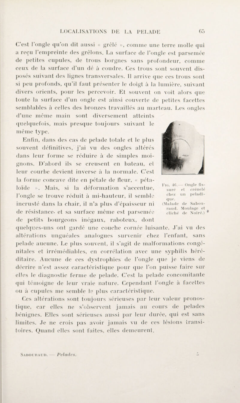 J C’est l’ongle qu’on dit aussi « grêlé », comme une terre molle qui a reçu l’empreinte des grêlons. La surface de l’ongle est parsemée de petites cupules, de trous borgnes sans profondeur, comme ceux de la surface d’un dé à coudre. Ces trous sont souvent dis¬ posés suivant des lignes transversales. II arrive que ces trous sont si peu profonds, qu’il faut présenter le doigt à la lumière, suivant divers orients, pour les percevoir. Et souvent on voit alors que toute la surface d’un ongle est ainsi couverte de petites facettes semblables à celles des bronzes travaillés au marteau. Les ongles d’une même main sont diversement atteints quelquefois, mais presque toujours suivant le même type. Enfin, dans des cas de pelade totale et le plus souvent définitives, j’ai vu des ongles altérés dans leur forme se réduire à de simples moi¬ gnons. D’abord ils se creusent en bateau, et leur courbe devient inverse à la normale. C’est la forme concave dite en pétale de fleur, « péta- loïde ». Mais, si la déformation s’accentue, l’ongle se trouve réduit à mi-hauteur, il semble incrusté dans la chair, il n’a plus d’épaisseur ni de résistance, et sa surface même est parsemée de petits bourgeons inégaux, raboteux, dont quelques-uns ont gardé une couche cornée luisante. J’ai vu des altérations unguéales analogues survenir chez l’enfant, sans pelade aucune. Le plus souvent, il s’agit de malformations congé¬ nitales et irrémédiables, en corrélation avec une syphilis héré¬ ditaire. Aucune de ces dystrophies de l’ongle que je viens de décrire n’est assez caractéristique pour que l’on puisse faire sur elles le diagnostic ferme de pelade. C’est la pelade concomitante qui témoigne de leur vraie nature. Cependant l’ongle à facettes ou à cupules me semble le plus caractéristique. Ces altérations sont toujours sérieuses par leur valeur pronos¬ tique, car elles ne s’observent jamais au cours de pelades bénignes. Elles sont sérieuses aussi par leur durée, qui est sans limites. Je ne crois pas avoir jamais vu de ces lésions transi¬ toires. Quand elles sont faites, elles demeurent. Fig. 4fi.— Ongle fis¬ suré et crénelé chez un peladi- que. (Malade de Sabou- raud. Moulage et cliché de N’oiré.) S A IU)l'H A l'I). Pelade s.