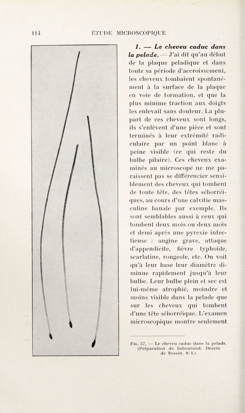 1. — Le cheveu caduc dans la pelade. —J’ai dit qu’au début de la plaque peladique et dans toute sa période d’accroissement, les cheveux tombaient spontané¬ ment à la surface de la plaque en voie de formation, et que la plus minime traction aux doigts les enlevait sans douleur. La plu¬ part de ces cheveux sont longs, ils s’enlèvent d’une pièce et sont terminés à leur extrémité radi¬ culaire par un point blanc à peine visible (ce qui reste du bulbe pilaire). Ces cheveux exa¬ minés au microscope ne me pa¬ raissent pas se différencier sensi¬ blement des cheveux qui tombent de toute tête, des têtes séborréi- ques, au cours d’une calvitie mas¬ culine banale par exemple. Ils sont semblables aussi à ceux qui tombent deux mois ou deux mois et demi après une pyrexie infec¬ tieuse : angine grave, attaque d’appendicite, fièvre typhoïde, scarlatine, rougeole, etc. On voit qu’à leur base leur diamètre di¬ minue rapidement jusqu’à leur bulbe. Leur bulbe plein et sec est lui-même atrophié, moindre et moins visible dans la pelade que sur les cheveux qui tombent d’une tête séborréique. L’examen microscopique montre seulement Fig. 57. — Le cheveu caduc dans la pelade. (Préparation de Sabouraud. Dessin de Bessin. 8/1.)