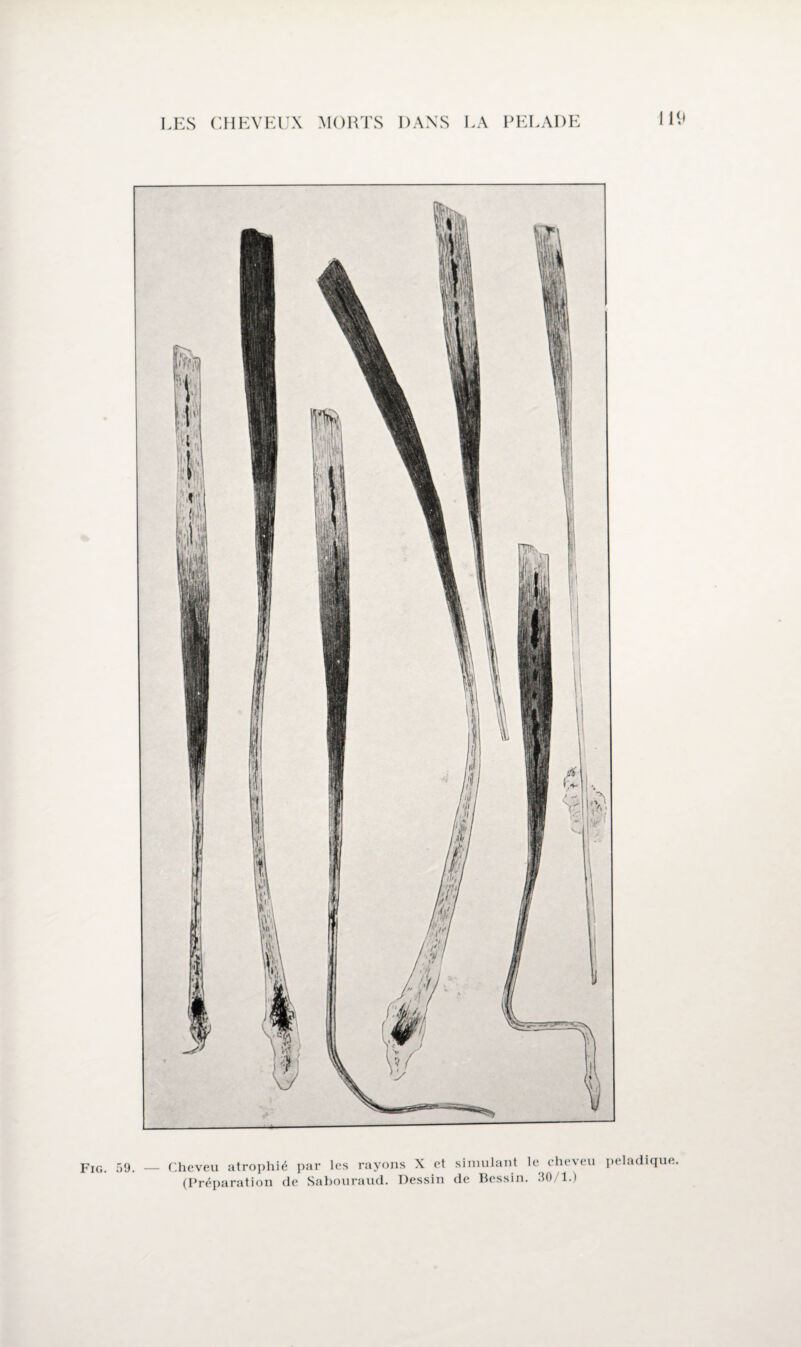 110 Fig. 59. — Cheveu atrophié par les rayons X et simulant le cheveu peladique.