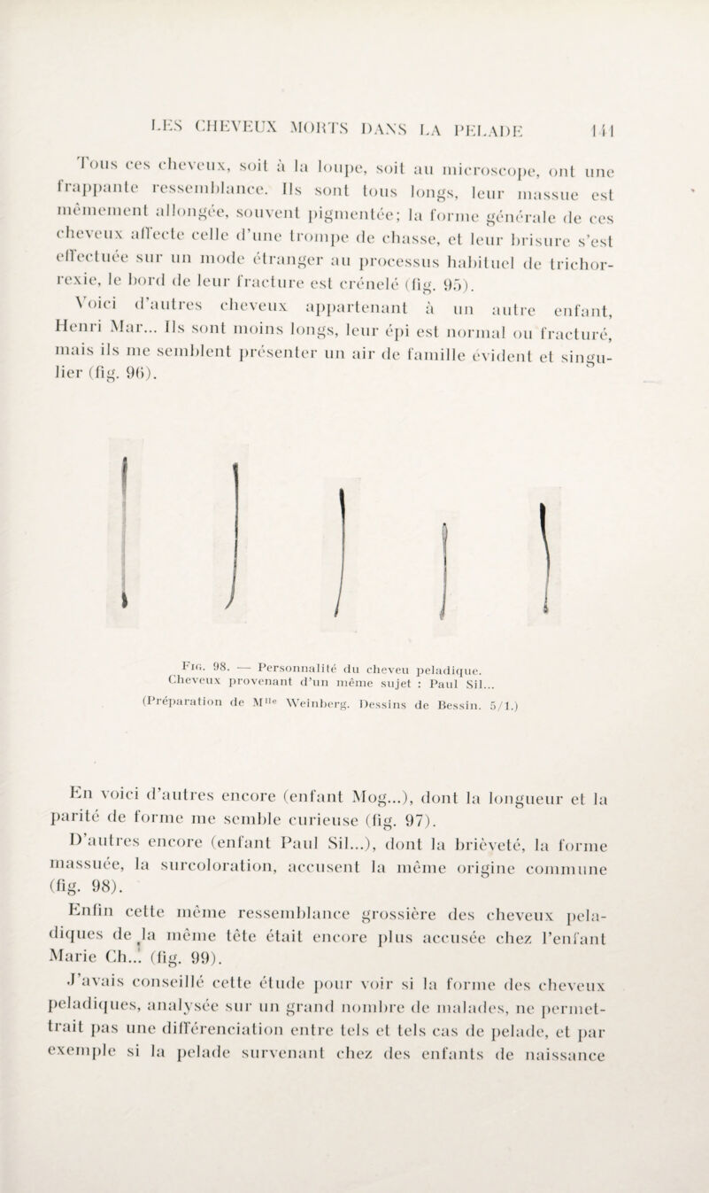 I ous ces cheveux, soit à la loupe, soit au microscope, ont une frappante ressemblance. Ils sont tous longs, leur massue est mêmement allongée, souvent pigmentée; la forme générale de ces cheveux affecte celle d’une trompe de chasse, et leur brisure s’est effectuée sur un mode étranger au processus habituel de trichor- rexie, le bord de leur fracture est crénelé (fig 95) Voici d’autres ciieveux appartenant à un autre enfant, Henri Mar... Ils sont moins longs, leur épi est normal ou fracturé, mais ils me semblent présenter un air de famille évident et singu- lier (fig. 96). i l it;. 98. Personnalité du cheveu peladique. Cheveux provenant d’un même sujet : Paul Sil... (Préparation de Weinberg. Dessins de Bessin. 5/1.) Ln \oici d autres encore (enfant Mog...), dont la longueur et la parité de forme me semble curieuse (lig. 97). I) autres encore (enfant Paul Sil...), dont la brièveté, la forme massuée, la surcoloration, accusent la meme origine commune (fig. 98). Enfin cette meme ressemblance grossière des cheveux pela- diques de la même tête était encore plus accusée chez l’enfant Marie Ch..', (fig. 99). J avais conseillé cette étude pour voir si la forme des cheveux peladiques, analysée sur un grand nombre de malades, ne permet¬ trait pas une différenciation entre tels et tels cas de pelade, et par exemple si la pelade survenant chez des enfants de naissance