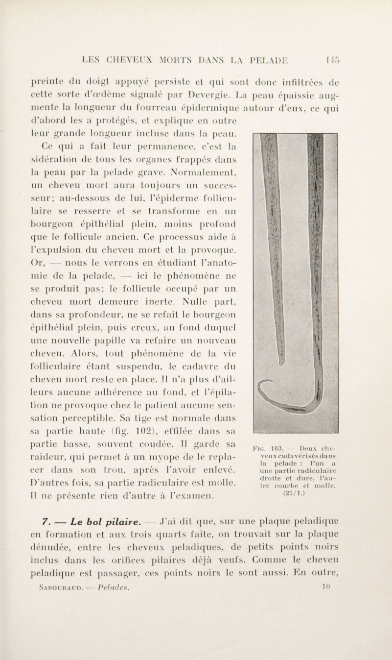 preinte du doigt appuyé persiste et qui sont donc infiltrées de cette sorte d’œdème signalé par Devergie. La peau épaissie aug¬ mente la longueur du fourreau épidermique autour d’eux, ce qui d’abord les a protégés, et explique en outre leur grande longueur incluse dans la peau. Ce qui a fait leur permanence, c’est la sidération de tous les organes frappés dans la peau par la pelade grave. Normalement, un cheveu mort aura toujours un succes¬ seur; au-dessous de lui, l’épiderme follicu¬ laire se resserre et se transforme en un bourgeon épithélial plein, moins profond que le follicule ancien. Ce processus aide à l’expulsion du cheveu mort et la provoque. Or, — nous le verrons en étudiant l’anato¬ mie de la pelade, — ici le phénomène ne se produit pas; le follicule occupé par un cheveu mort demeure inerte. Nulle part, dans sa profondeur, ne se refait le bourgeon épithélial plein, puis creux, au fond duquel une nouvelle papille va refaire un nouveau cheveu. Alors, tout phénomène de la vie folliculaire étant suspendu, le cadavre du cheveu mort reste en place. Il n’a plus d’ail¬ leurs aucune adhérence au fond, et l’épila¬ tion ne provoque chez le patient aucune sen¬ sation perceptible. Sa tige est normale dans sa partie haute (fig. 102), effilée dans sa partie basse, souvent coudée. 11 garde sa raideur, qui permet à un myope de le repla¬ cer dans son trou, après l’avoir enlevé. D’autres fois, sa partie radiculaire est molle. Il ne présente rien d’autre à l’examen. Fig. 103. — Deux che¬ veux cadavérisés dans la pelade : l’un a une partie radiculaire droite et dure, l’au¬ tre courbe et molle. (25/1.) 7. — Le bol pilaire. — .J’ai dit que, sur une plaque peladique en formation et aux trois quarts faite, on trouvait sur la plaque dénudée, entre les cheveux peladiques, de petits points noirs inclus dans les orifices pilaires déjà veufs. Comme le cheveu peladique est passager, ces points noirs le sont aussi. En outre, 10 Sarouhaud. — Pelades.