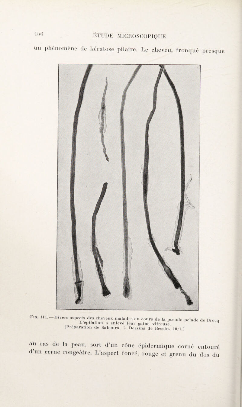 un phénomène de kératose pilaire. Le cheveu, tronqué presque Fig. 111. Divers aspects des cheveux malades au cours de la pseudo-pelade de Broccr F épilation a enlevé leur gaine vitreuse. (Préparation de Saboura i. Dessins de Bessin. 10/1.) au ras de la peau, sort d’un cône épidermique corné entouré d’un cerne rougeâtre. L’aspect foncé, rouge et grenu du dos du