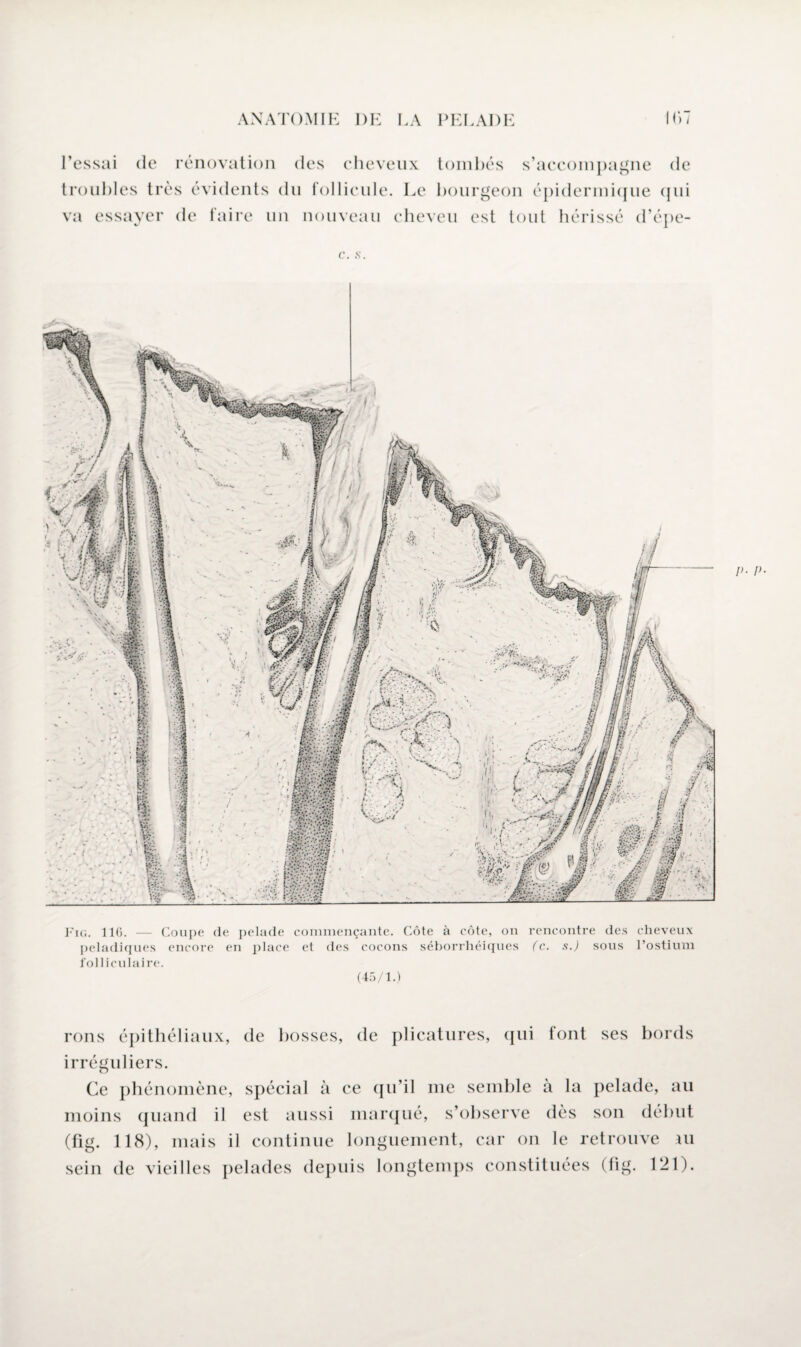 ■ ^ -j l’essai de rénovation des cheveux tombés s’accompagne de troubles très évidents du follicule. Le bourgeon épidermique qui va essayer de faire un nouveau cheveu est tout hérissé d’épe- c. s. J). p. Fig. 11(5. — Coupe (le pelade commençante. Côte à côte, on rencontre des cheveux peladiques encore en place et des cocons séborrhéiques (c. s.) sous l’ostium folliculaire. (45/1.) rons épithéliaux, irréguliers. de bosses, de plicatures, (j ni font ses bords Ce phénomène, spécial à moins quand il est aussi (fig. 118), mais il continue ce qu’il me semble à la pelade, au marqué, s’observe dès son début longuement, car on le retrouve au o sein de vieilles pelades depuis longtemps constituées (fig- 121).