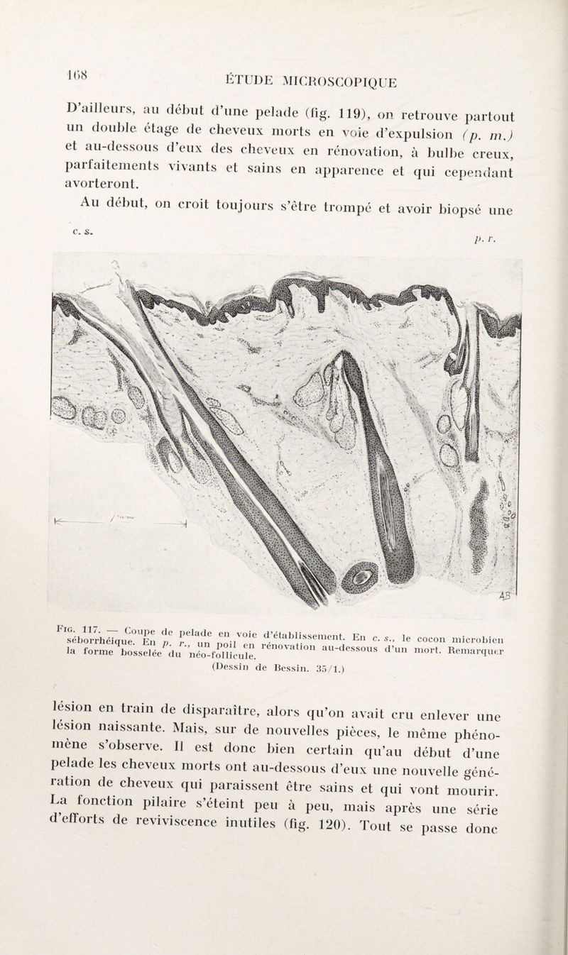 D ailleurs, au début d une pelade (lig. 119), on retrouve partout un double étage de cheveux morts en voie d’expulsion (p. m.) et au-dessous d’eux des cheveux en rénovation, à bulbe creux, parfaiteinents vivants et sains en apparence et qui cependant avorteront. Au début, on croit toujours s’être trompé et avoir biopsé une c. s. p. r. séborrhéiaue Fn d 1 1 de en voie d etablissement. En c. 5., senoirbeique. En p. r., un poil en rénovation au-dessous d’i la forme bosselée du néo-follicule. dessous d 1 (Dessin de Bessin. 35/1.) cocon microbien mort. Remarquer lésion en train de disparaître, alors qu’on avait cru enlever une lésion naissante. Mais, sur de nouvelles pièces, le même phéno¬ mène s’observe. Il est donc bien certain qu’au début d’une pelade les cheveux morts ont au-dessous d’eux une nouvelle géné¬ ration de cheveux qui paraissent être sains et qui vont mourir. La fonction pilaire s’éteint peu à peu, mais après une série d efforts de reviviscence inutiles (fig. 120). Tout se passe donc