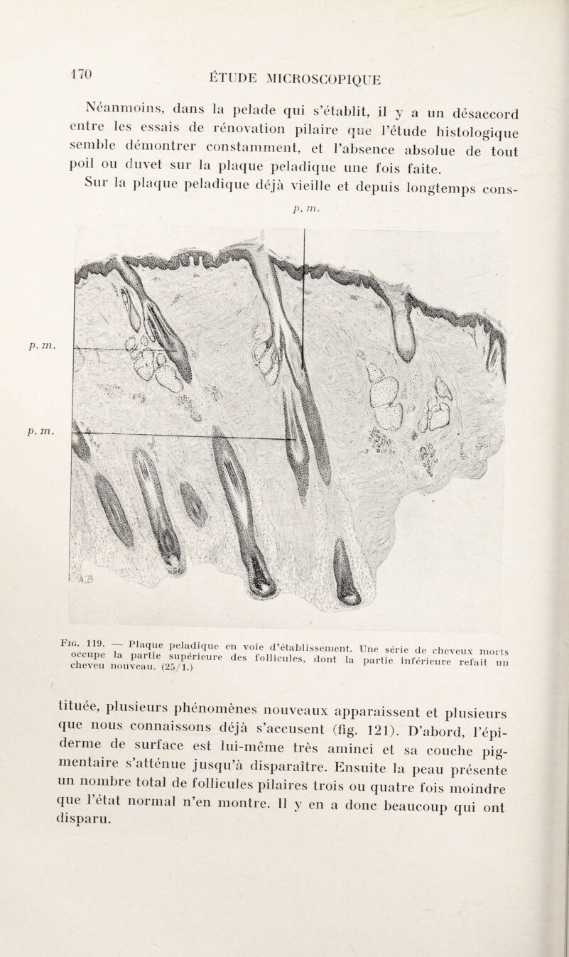 Néanmoins, dans la pelade qui s’établit, il y a un désaccord entre les essais de rénovation pilaire que l’étude histologique semble démontrer constamment, et l’absence absolue de tout poil ou duvet sur la plaque peladique une fois faite. Sur la plaque peladique déjà vieille et depuis longtemps cons- p. m. p. m. p. m. Fig. 119. — Plaque peladique en voie d’établissement, occupe la partie supérieure des follicules, dont la cheveu nouveau. (25/1.) Une série de cheveux morts partie inférieure refait un tituée, plusieurs phénomènes nouveaux apparaissent et plusieurs que nous connaissons déjà s’accusent (fig. 121). D’abord, l’épi- denne de surface est lui-même très aminci et sa couche pig¬ mentaire s’atténue jusqu’à disparaître. Ensuite la peau présente un nombre total de follicules pilaires trois ou quatre fois moindre que 1 état normal n’en montre. Il y en a donc beaucoup qui ont disparu. JL