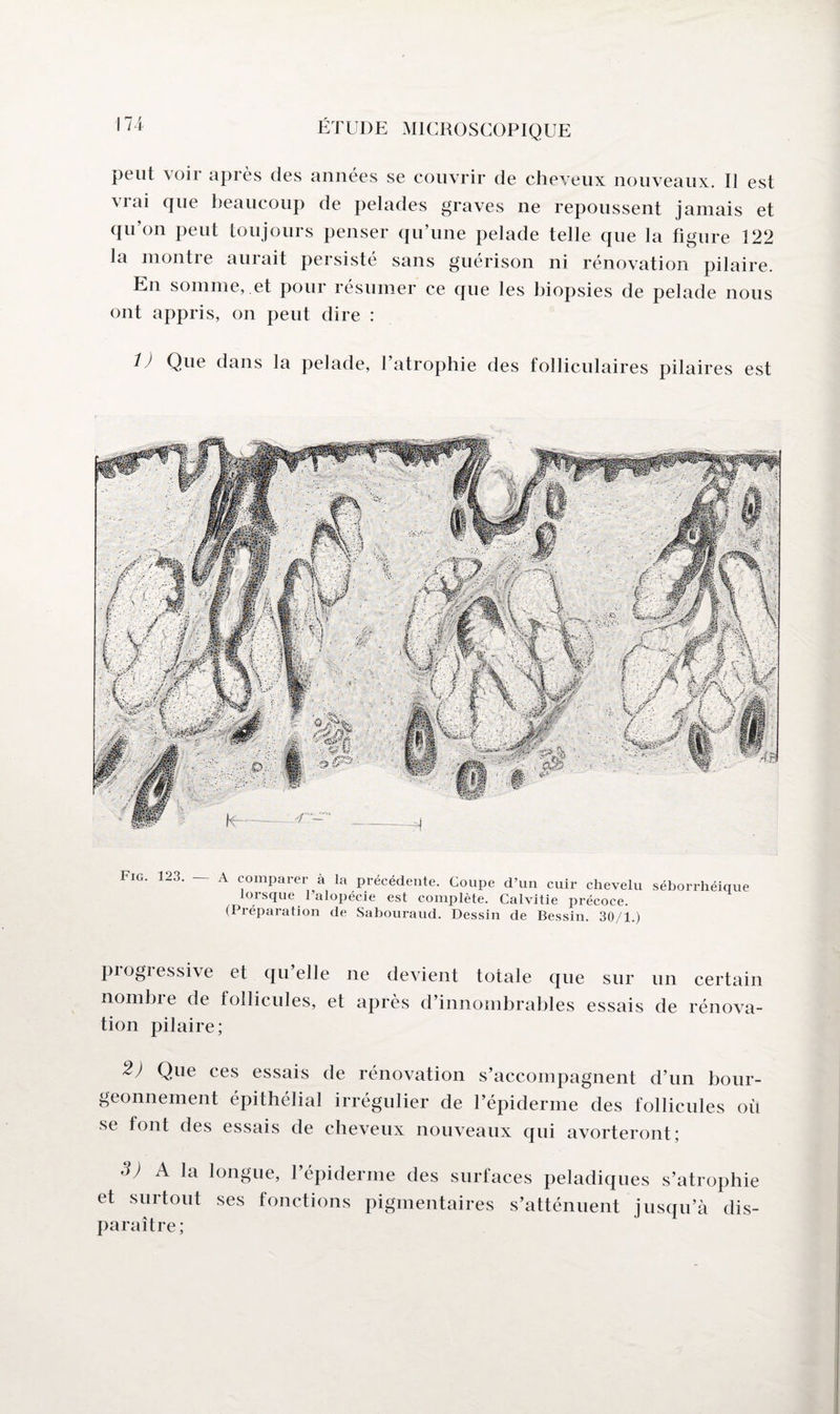 peut voir après des années se couvrir de cheveux nouveaux. Il est vrai que beaucoup de pelades graves ne repoussent jamais et qu’on peut toujours penser qu’une pelade telle que la figure 122 la montre aurait persisté sans guérison ni rénovation pilaire. En somme, et pour résumer ce que les biopsies de pelade nous ont appris, on peut dire : i) Que dans la pelade, l’atrophie des folliculaires pilaires est Fig. 123. — A comparer à la précédente. Coupe d’un cuir chevelu séborrhéique lorsque 1 alopécie est complète. Calvitie précoce. (Préparation de Sabouraud. Dessin de Bessin. 30/1.) piogiessive et quelle ne devient totale que sur un certain nombre de follicules, et après d’innombrables essais de rénova¬ tion pilaire; 2) Que ces essais de rénovation s’accompagnent d’un bour¬ geonnement épithélial irrégulier de l’épiderme des follicules où se font des essais de cheveux nouveaux qui avorteront; d; A la longue, l’épiderme des surfaces peladiques s’atrophie et surtout ses fonctions pigmentaires s’atténuent jusqu’à dis¬ paraître;