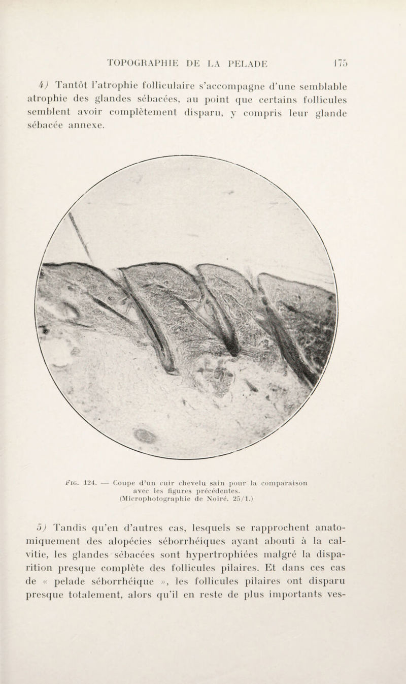 b) I antot l’atrophie folliculaire s’accompagne d’une semblable atrophie des glandes sébacées, au point que certains follicules semblent avoir complètement disparu, y compris leur glande sébacée annexe. r’iG. 124. — Coupe d’un cuir chevelu sain pour la comparaison avec les figures précédentes. (Microphotographie de Noiré. 25/1.) 5) Tandis qu’en d’autres cas, lesquels se rapprochent anato¬ miquement des alopécies séborrhéiques ayant abouti à la cal¬ vitie, les glandes sébacées sont hypertrophiées malgré la dispa¬ rition presque complète des follicules pilaires. Et dans ces cas de « pelade séborrhéique », ies follicules pilaires ont disparu presque totalement, alors qu'il en reste de plus importants ves-