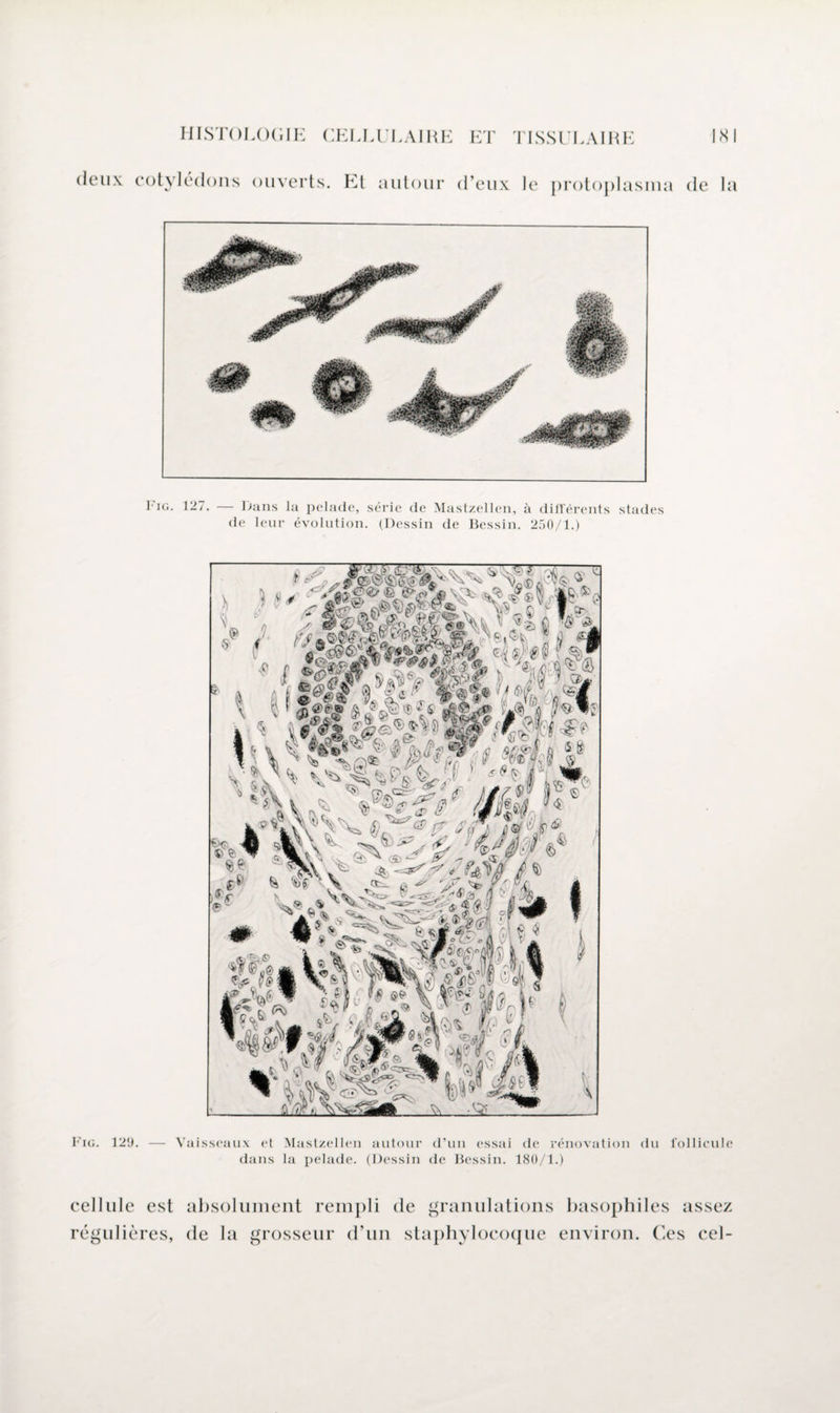 » ouverts. Et autour d’eux le protoplasina de la Fig. 127. — Dans la pelade, série de Mastzellen, à différents stades de leur évolution. (Dessin de Bessin. 250/1.) Fig. 120. — Vaisseaux et Mastzellen autour d’un essai de rénovation du follicule dans la pelade. (Dessin de Bessin. 180/1.) cellule est absolument rempli de granulations basophiles assez régulières, de la grosseur d’un staphylocoque environ. Ces cel-