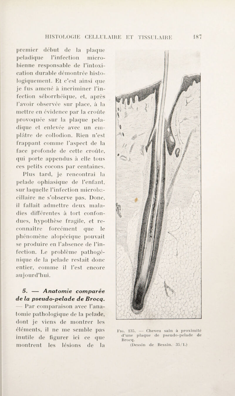 premier début de la plaque peladique l’infection micro¬ bienne responsable de l’intoxi¬ cation durable démontrée histo¬ logiquement. Et c’est ainsi que je fus amené à incriminer l’in¬ fection séborrhéique, et, après l’avoir observée sur place, à la mettre en évidence par la croûte provoquée sur la plaque pela¬ dique et enlevée avec un em~ plâtre de collodion. Rien n’est frappant comme l’aspect de la face profonde de cette croûte, (jui porte appendus à elle tous ces petits cocons par centaines. Plus tard, je rencontrai la pelade ophiasique de l’enfant, sur laquelle l’infection microba¬ cillaire ne s’observe pas. Donc, il fallait admettre deux mala¬ dies différentes à tort confon¬ dues, hypothèse fragile, et re¬ connaître forcément que le phénomène alopécique pouvait se produire en l’absence de l’in¬ fection. Le problème pathogé¬ nique de la pelade restait donc entier, comme il l’est encore aujourd’hui. 5. — Anatomie comparée de la pseudo-pelade de Brocq. Par comparaison avec l’ana¬ tomie pathologique de la pelade, dont je viens de montrer les éléments, il ne me semble pas inutile de figurer ici ce que montrent les lésions de la Fig. 135. — Cheveu sain à proximité d’une plaque de pseudo-pelade de Brocq. (Dessin de Bessin. 35/1.)