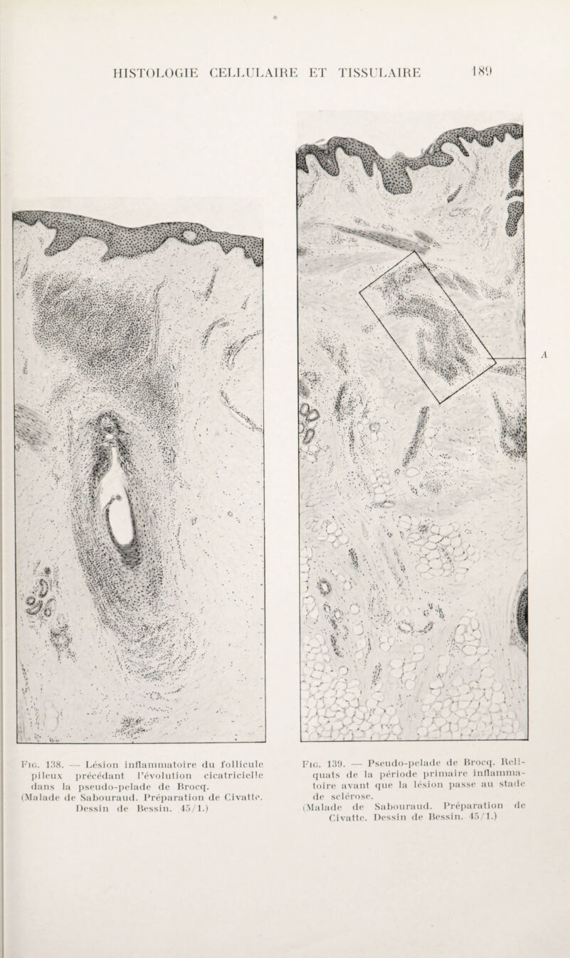 Fie. 138. pileux dans 1 (Malade Lésion inflammatoire du follicule précédant l’évolution cicatricielle a pseudo-pelade de Brocq. de Sabouraud. Préparation de Civatle. Dessin de Bessin. 45/1.) Fig. 139. — Pseudo-pelade de Brocq. Reli¬ quats de la période primaire inflamma¬ toire avant que la lésion passe au stade de sclérose. i Malade de Sabouraud. Préparation de Civatte. Dessin de Bessin. 45/1.)