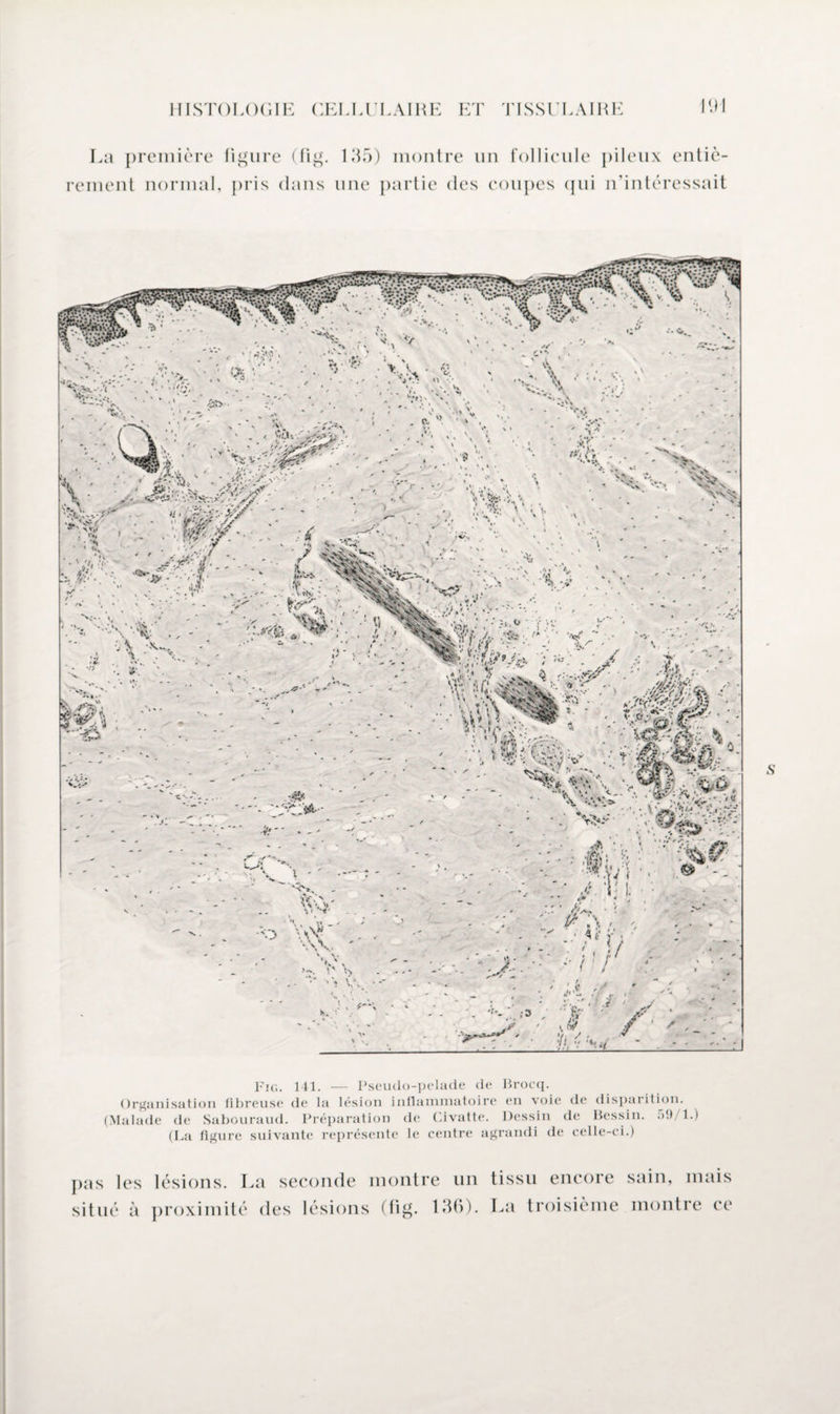 La première figure (lig. renient normal, pris dans 135) montre un follicule une partie des coupes qui pileux entiè- n’intéressait Fig. 141. — Pseudo-pelade de Brocq. Organisation fibreuse de la lésion inflammatoire en voie de disparition. (Malade de Sabouraud. Préparation de Civatte. Dessin de Bessin. 59/1.) (La figure suivante représente le centre agrandi de celle-ci.) pas les lésions. La seconde montre un tissu encore sain, mais situé à proximité des lésions (lig. 136). La troisième montre ce