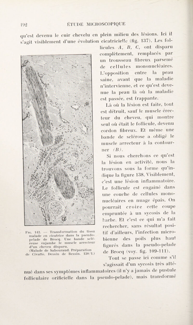 s’agit visiblement d’une évolution o Fig. 142. — Transformation du tissu malade en cicatrice dans la pseudo¬ pelade de Brocq. Une bande sclé¬ reuse enjambe le muscle arrecteur d’un cheveu disparu. (Malade de Sabouraud. Préparation de Civatte. Dessin de Bessin. 120/1.) lésions. Ici il 137). Les fol¬ licules A, B, C, ont disparu complètement, remplacés par un trousseau fibreux parsemé de cellules mononucléaires. L’opposition entre la peau saine, avant que la maladie n’intervienne, et ce qu’est deve¬ nue la peau là où la maladie est passée, est frappante. Là où la lésion est taite, tout est détruit, sauf le muscle érec- teur du cheveu, qui montre seul où était le follicule, devenu cordon fibreux. Et même une bande de sclérose a obligé le muscle arrecteur à la contour¬ ner (B). Si nous cherchons ce qu’est la lésion en activité, nous la trouvons sous la forme qu’in¬ dique la figure 138. Visiblement, c’est une lésion inflammatoire. Le follicule est engainé dans une couche de cellules mono¬ nucléaires en nuage épais. On pourrait croire cette coupe empruntée à un syeosis de la barbe. Et c’est ce qui m’a fait rechercher, sans résultat posi¬ tif d’ailleurs, l’infection micro¬ bienne des poils plus haut figurés dans la pseudo-pelade de Brocq (vov. fig. 109-111). Tout se passe ici comme s’il s’agissait d’un syeosis très atté- mé dans ses symptômes inflammatoires (il n’y a jamais de pustule olliculaire orificielle dans la pseudo-pelade), mais transionné 192 ÉTUDE MICROSCOPIQUE qu’est devenu le cuir chevelu en plein milieu des cicatricielle (fig.