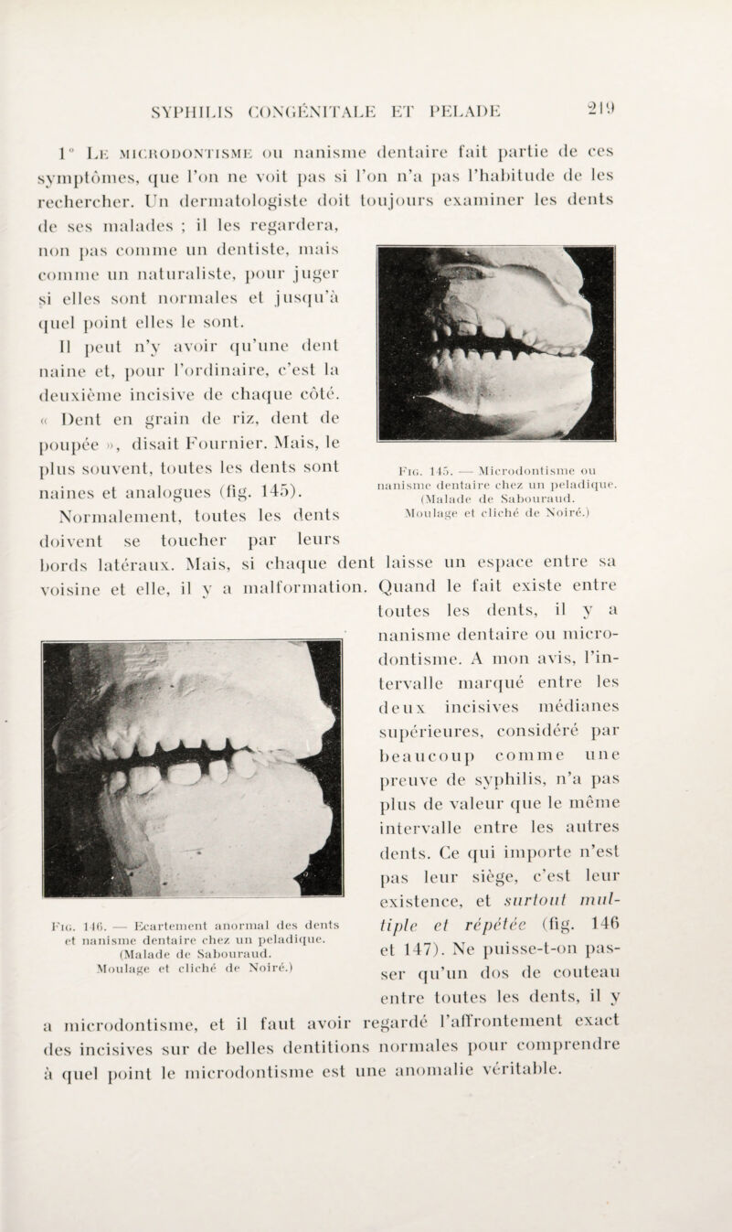 2 I \) Fig. 145. — Microdontisme ou nanisme dentaire chez un peladique. (Malade de Sabouraud. Moulage et cliché de Noire.) 1° Lk microdontisme ou nanisme dentaire fait partie de ces symptômes, que l’on ne voit pas si l’on n’a pas l’habitude de les rechercher. Un dermatologiste doit toujours examiner les dents de ses malades ; il les regardera, non pas comme un dentiste, mais comme un naturaliste, pour juger si elles sont normales et jusqu’à quel point elles le sont. Il peut n’y avoir qu’une dent naine et, pour l’ordinaire, c’est la deuxième incisive de chaque côté. » Dent en grain de riz, dent de poupée », disait Fournier. Mais, le plus souvent, toutes les dents sont naines et analogues (fig. 145). Normalement, toutes les dents doivent se toucher par leurs bords latéraux. Mais, si chaque dent laisse un espace entre sa voisine et elle, il v a malformation. Quand le fait existe entre toutes les dents, il y a nanisme dentaire ou micro¬ dontisme. A mon avis, l’in¬ tervalle marqué entre les deux incisives médianes supérieures, considéré par beaucoup comme une preuve de syphilis, n’a pas plus de valeur que le même intervalle entre les autres dents. Ce qui importe n’est pas leur siège, c’est leur existence, et surtout mul¬ tiple et répétée (fig. 146 et 147). Ne puisse-t-on pas¬ ser qu’un dos de couteau Fig. 146. — Ecartement anormal des dents et nanisme dentaire chez un peladique. (Malade de Sabouraud. Moulage et cliché de Noire.) entre toutes les dents, il y a microdontisme, et il faut avoir regarde 1 affrontement exact des incisives sur de belles dentitions normales pour compiendie à quel point le microdontisme est une anomalie véiitable.