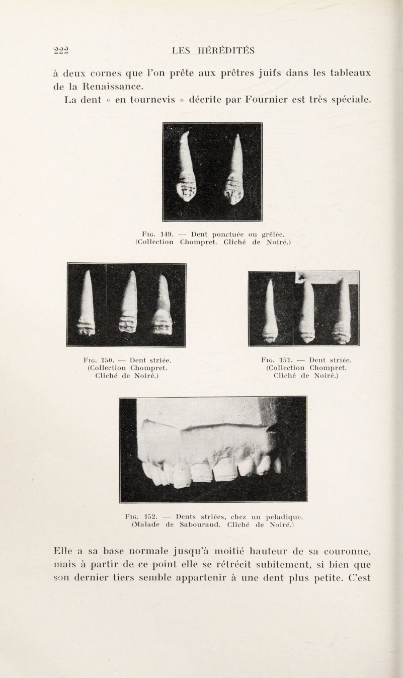 à deux cornes que l’on prête aux prêtres juifs dans les tableaux de la Renaissance. La dent « en tournevis » décrite par Fournier est très spéciale. Fig. 149. -—■ Dent ponctuée ou grêlée. (Collection Chompret. Cliché de Noiré.) Fig. 150. -— Dent striée. (Collection Chompret. Cliché de Noiré.) Fig. 151. — Dent striée. (Collection Chompret. Cliché de Noiré.) Fig. 152. — Dents striées, chez un peladique. (Malade de Sabouraud. Cliché de Noiré.) Elle a sa base normale jusqu’à moitié hauteur de sa couronne, mais à partir de ce point elle se rétrécit subitement, si bien que son dernier tiers semble appartenir à une dent plus petite. C’est