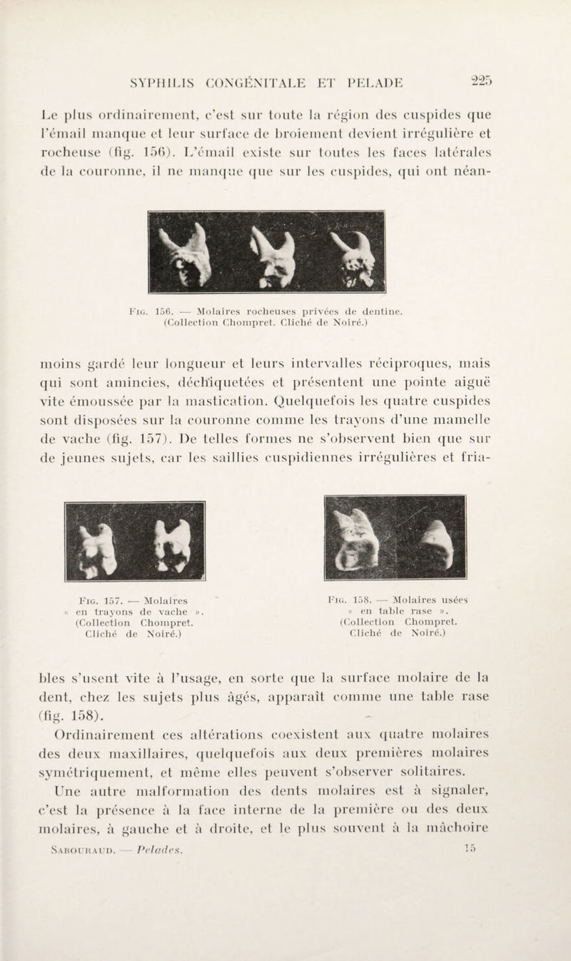 Le plus ordinairement, c’est sur toute la région des cuspides que l’émail manque et leur surface de broiement devient irrégulière et rocheuse (fig. 150). L’émail existe sur toutes les faces latérales de la couronne, il ne manque que sur les cuspides, qui ont néan- Fig. 156. — Molaires rocheuses privées de dentine. (Collection Chonipret. Cliché de Noiré.) moins gardé leur longueur et leurs intervalles réciproques, mais qui sont amincies, déchiquetées et présentent une pointe aiguë vite émoussée par la mastication. Quelquefois les quatre cuspides sont disposées sur la couronne comme les trayons d’une mamelle de vache (fig. 157). De telles formes ne s’observent bien que sur de jeunes sujets, car les saillies cuspidiennes irrégulières et fria- Fig. 157. •— Molaires « en trayons de vache ». (Collection Chonipret. Cliché de Noiré.) Fig. 158. — Molaires usées « en table rase ». (Collection Chonipret. Cliché de Noiré.) blés s’usent vite à l’usage, en sorte que la surface molaire de la dent, chez les sujets plus âgés, apparaît comme une table rase (fig. 158). Ordinairement ces altérations coexistent aux quatre molaires des deux maxillaires, quelquefois aux deux premières molaires symétriquement, et meme elles peuvent s’observer solitaires. Une autre mal formation des dents molaires est à signaler, c’est la présence à la face interne de la première ou des deux molaires, à gauche et à droite, et le plus souvent à la mâchoire 15 Sa hoc h aud. Pelades.