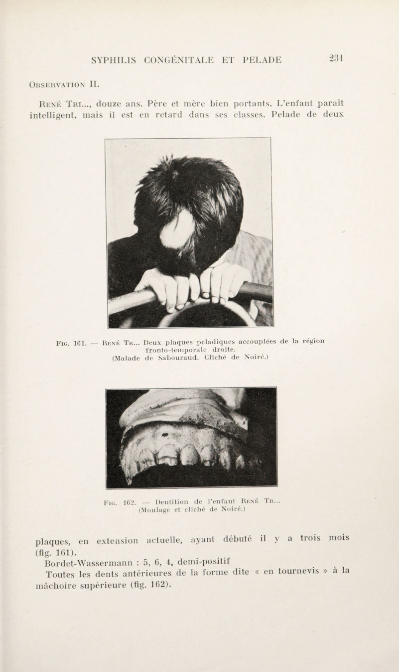 MI Observation IL René Tri..., douze ans. Père et mère bien intelligent, mais il est en retard dans ses portants. L’enfant paraît classes. Pelade de deux Fig. 161. — René Tr... Deux plaques peladiques accouplées de la région fronto-temporale droite. (Malade de Sabouraud. Cliché de Noiré.) Fig. 162. — Dentition de l’enfant René Tr... (Moulage et cliché de Noiré.) plaques, en extension actuelle, ayant débuté (fig. 161). Bordet-Wassermann : 5, 6, 4, demi-positif Toutes les dents antérieures de la forme dite il y a trois mois « en tournevis » à la mâchoire supérieure (fig. 102).