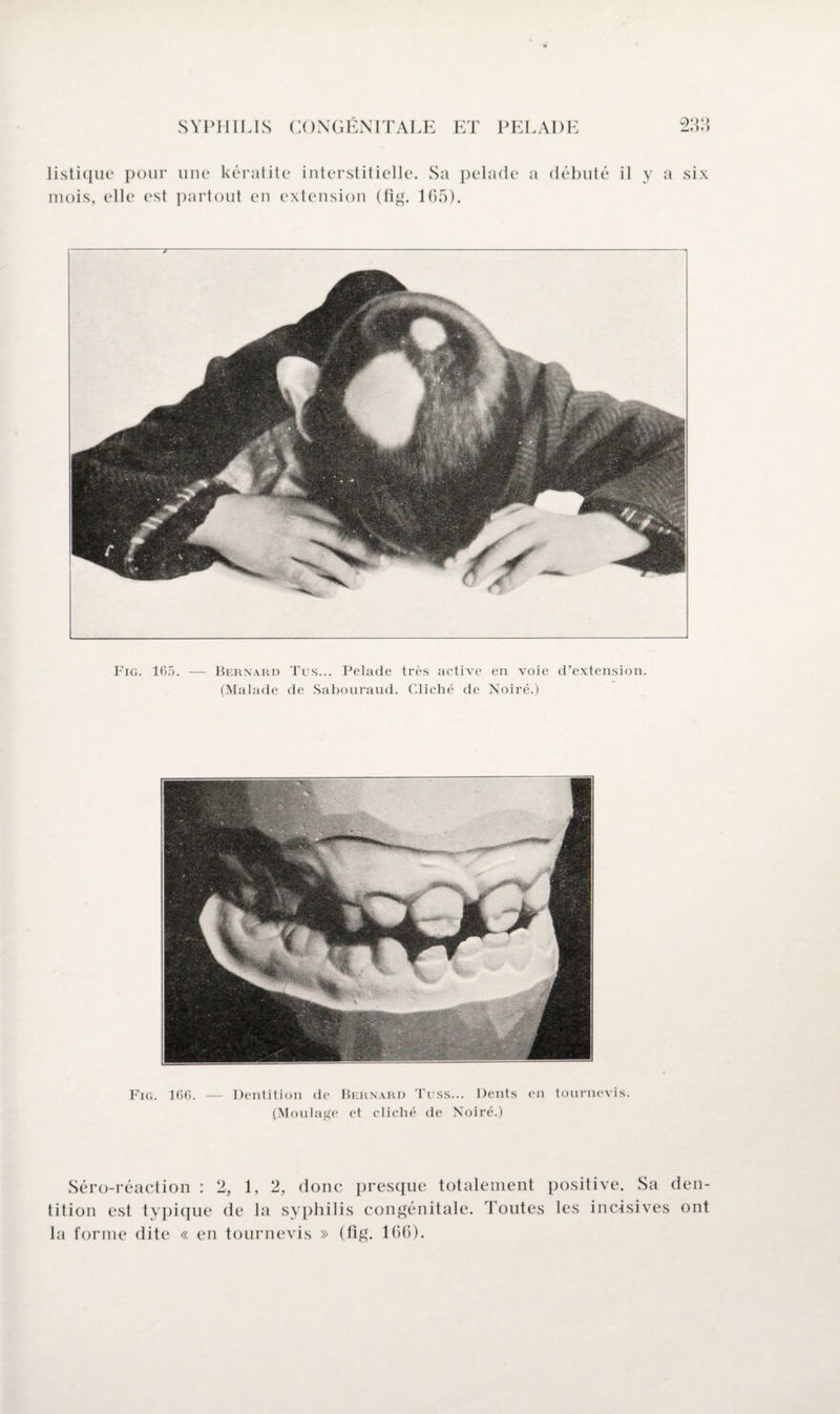 *) listique pour line kératite interstitielle. Sa pelade a débuté il mois, elle est partout en extension (fig. 165). y a six Fig. 165. — Bernard Tus... Pelade très active en voie d’extension. (Malade de Sabouraud. Cliché de Noiré.) Fig. 166. — Dentition de Bernard Tuss... Dents en tournevis. (Moulage et cliché de Noiré.) Séro-réaction : 2, 1, 2, donc presque totalement positive. Sa den¬ tition est typique de la syphilis congénitale. Toutes les incisives ont la forme dite « en tournevis » (fig. 166).