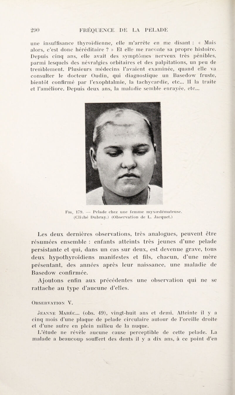 une insuffisance thyroïdienne, elle m’arrête en me disant : « Mais alors, c’est donc héréditaire ? » Et elle me raconte sa propre histoire. Depuis cinq ans, elle avait des symptômes nerveux très pénibles, parmi lesquels des névralgies orbitaires et des palpitations, un peu de tremblement. Plusieurs médecins l’avaient examinée, quand elle va consulter le docteur Oudin, qui diagnostique un Basedow fruste, bientôt confirmé par l’exophtalmie, la tachycardie, etc... II la traite et l’améliore. Depuis deux ans, la maladie semble enrayée, etc... Fig. 179. — Pelade chez une femme myxœdémateuse. (Clishé Dubray.) (Observation de L. Jacquet.) Les deux dernières observations, très analogues, peuvent être résumées ensemble : enfants atteints très jeunes d’une pelade persistante et qui, dans un cas sur deux, est devenue grave, tous deux hypothyroïdiens manifestes et fils, chacun, d’une mère présentant, des années après leur naissance, une maladie de Basedow confirmée. Ajoutons enfin aux précédentes une observation qui ne se rattache au type d’aucune d’elles. Observation Y. Jeanne Maréc... (obs. 49), vingt-huit ans et demi. Atteinte il y a cinq mois d’une plaque de pelade circulaire autour de l’oreille droite et d’une autre en plein milieu de la nuque. L’étude ne révèle aucune cause perceptible de cette pelade. La malade a beaucoup souffert des dents il y a dix ans, à ce point d’en