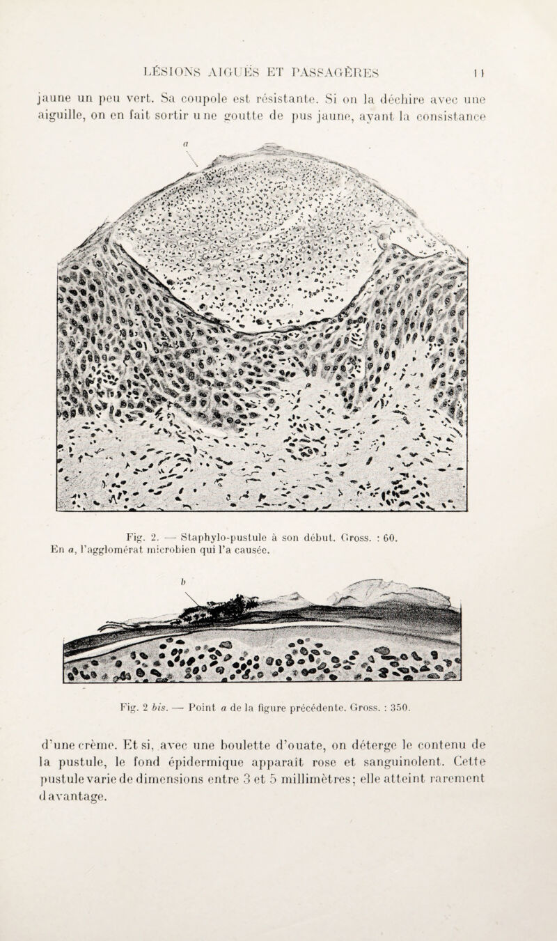 jaune un peu vert. Sa coupole est résistante. Si on la déchire avec une aiguille, on en fait sortir une goutte de pus jaune, ayant la consistance Fig. 2. — Staphylo-pustule à son début. Gross. : 60. En a, l’agglomérat microbien qui l’a causée. Fig. 2 bis. — Point a de la figure précédente. Gross. : 350. d’une crème. Et si, avec une boulette d’ouate, on déterge le contenu de la pustule, le fond épidermique apparaît rose et sanguinolent. Cette pustule varie de dimensions entre 3 et 5 millimètres; elle atteint rarement davantage.