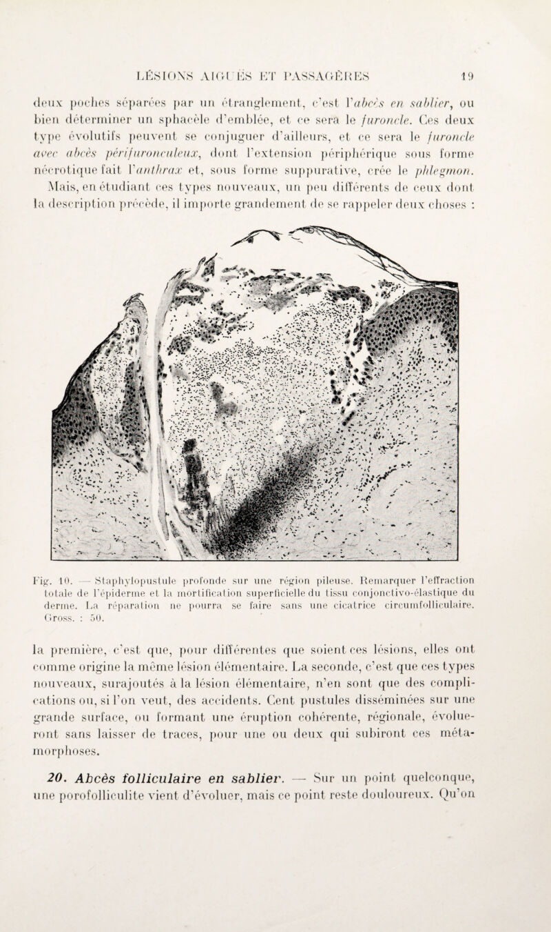 deux poches séparées par un étranglement, c’est Vabres en sablier, ou bien déterminer un sphacèle d’emblée, et ce sera le furoncle. Ces deux type évolutifs peuvent se conjuguer d’ailleurs, et ce sera le furoncle arec abcès périfuronculeux, dont l’extension périphérique sous forme nécrotique fait Vanthrax et, sous forme suppurative, crée le phlegmon. Mais, en étudiant ces types nouveaux, un peu différents de ceux dont la description précède, il importe grandement de se rappeler deux choses : Fig. 10. — Staphylopustule profonde sur une région pileuse. Remarquer l’effraction totale de l’épiderme et la mortification superficielle du tissu conjonctivo-élastique du derme. La réparation ne pourra se faire sans une cicatrice circumfolliculaire. Gross. : 5U. la première, c’est que, pour différentes que soient ces lésions, elles ont comme origine la même lésion élémentaire. La seconde, c’est que ces types nouveaux, surajoutés à la lésion élémentaire, n’en sont que des compli¬ cations ou, si l’on veut, des accidents. Cent pustules disséminées sur une grande surface, ou formant une éruption cohérente, régionale, évolue¬ ront sans laisser de traces, pour une ou deux qui subiront ces méta¬ morphoses. 20. Abcès folliculaire en sablier. — Sur un point quelconque, une porofolliculite vient d’évoluer, mais ce point reste douloureux. Qu’on