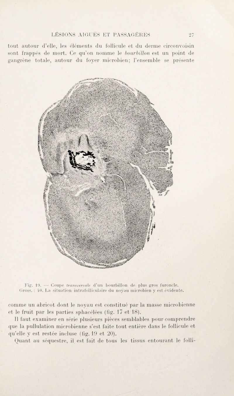 tout autour d’elle, les éléments du follicule et du derme circonvoisin sont frappés de mort. Ce qu’on nomme le bourbillon est un point de gangrène totale, autour du foyer microbien; l’ensemble se présente Fig. 19. — Coupe transversale d’un bourbillon de plus gros furoncle. Gross. : 40. La situation intrafolliculaire du noyau microbien y est évidente. comme un abricot dont le noyau est constitué par la masse microbienne et le fruit par les parties sphacélées (fig. 17 et 18). 11 faut examiner en série plusieurs pièces semblables pour comprendre que la pullulation microbienne s’est faite tout entière dans le follicule et qu’elle y est restée incluse (fig. 19 et 20). Quant au séquestre, il est fait de tous les tissus entourant le folli-