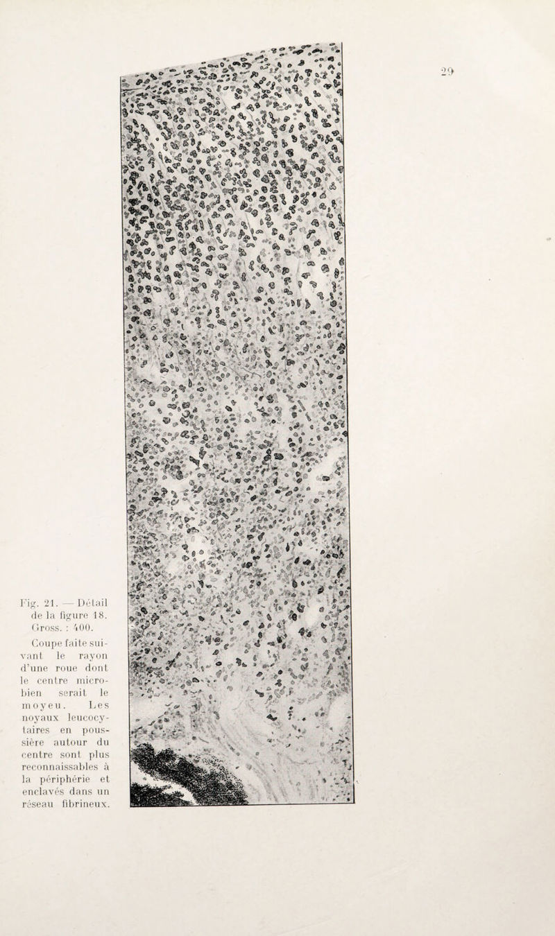 Fig. 21. — Détail de la figure 18. Gross. : 400. Coupe faite sui¬ vant. le rayon d’une roue dont le centre micro¬ bien serait le moyeu. Les noyaux leucocy¬ taires en pous¬ sière autour du centre sont plus reconnaissables à la périphérie et enclavés dans un réseau fibrineux. W* •- •tfajjs. S : *&*.