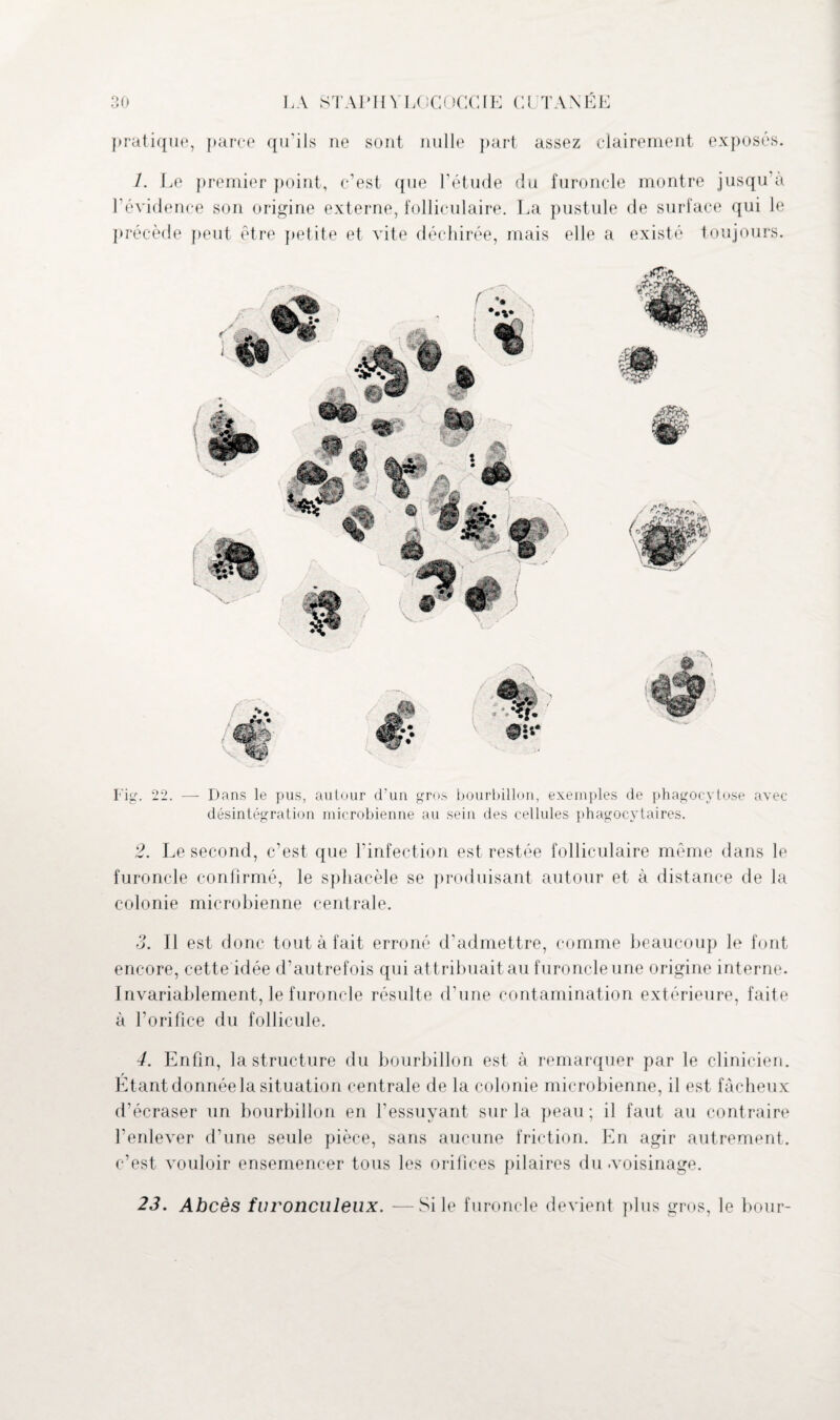 pratique, parce qu’ils ne sont nulle part assez clairement exposés. 1. Le premier point, c’est que l’étude du furoncle montre jusqu’à l’évidence son origine externe, folliculaire. La pustule de surface qui le précède peut être petite et vite déchirée, mais elle a existé toujours. Fig. 22. — Dans le pus, autour d’un gros bourbillon, exemples de phagocytose avec désintégration microbienne au sein des cellules phagocytaires. 2. Le second, c’est que l’infection est restée folliculaire même dans le furoncle confirmé, le spliacèle se produisant autour et à distance de la colonie microbienne centrale. 3. Il est donc tout à fait erroné d’admettre, comme beaucoup le font encore, cette idée d’autrefois qui attribuait au furoncle une origine interne. Invariablement, le furoncle résulte d’une contamination extérieure, faite à l’orifice du follicule. 4. Enfin, la structure du bourbillon est à remarquer par le clinicien. r Etant donnée la situation centrale de la colonie microbienne, il est fâcheux d'écraser un bourbillon en l’essuyant sur la peau; il faut au contraire l’enlever d’une seule pièce, sans aucune friction. En agir autrement, c’est- vouloir ensemencer tous les orifices pilaires du .voisinage. 23. Abcès furonculeux. —Si le furoncle devient plus gros, le bour-