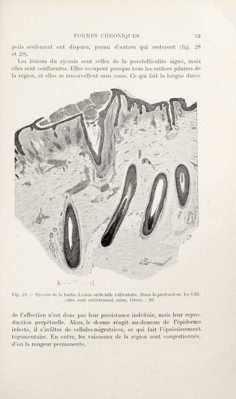 poils seulement ont disparu, parmi d’autres qui resteront (fig. 28 et 29). Les lésions du sycosis sont celles de la porofolliculite aiguë, mais elles sont confluentes. Elles occupent presque tous les orifices pilaires de la région, et elles se renouvellent sans cesse. Ce qui fait la longue durée K—r~ - >i Fig. 29.— Sycosis de la barbe. Lésion orificielle folliculaire. Dans la profondeur, les folli¬ cules sont entièrement sains. Gross. : 20. de l’affection n’est donc pas leur persistance indéfinie, mais leur repro¬ duction perpétuelle. Alors, le derme réagit au-dessous de l’épiderme infecté, il s’infiltre de cellules migratrices, ce qui fait l’épaississement tégumentaire. En outre, les vaisseaux de la région sont congestionnés, d’où la rougeur permanente.