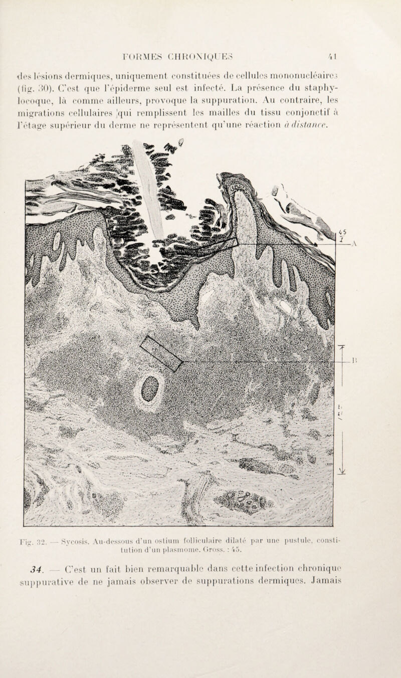 clés lésions dermiques, uniquement constituées de cellules mononucléaires (fig. 30). C’est que l’épiderme seul est infecté. La présence du staphy¬ locoque, là comme ailleurs, provoque la suppuration. Au contraire, les migrations cellulaires 'qui remplissent les mailles du tissu conjonctif à l'étage supérieur du Tine ne représentent qu’une réaction à distance. ç *- . ’ V. - .... HfejA A. ... * . W-A . -v v.r. A; W. t.i.. ■ -v v ' ' ........ ... F Wv - •••■- i| : *$!§§§$& : 'C A Ak Fi<i’. 32. — Sycosis. Au-dessous d’un ostium folliculaire dilaté par une pustule, consti¬ tution d’un plasmome. Gross. : 45. 34. — C’est un fait bien remarquable dans cette infection chronique suppurative de ne jamais observer de suppurations dermiques. Jamais