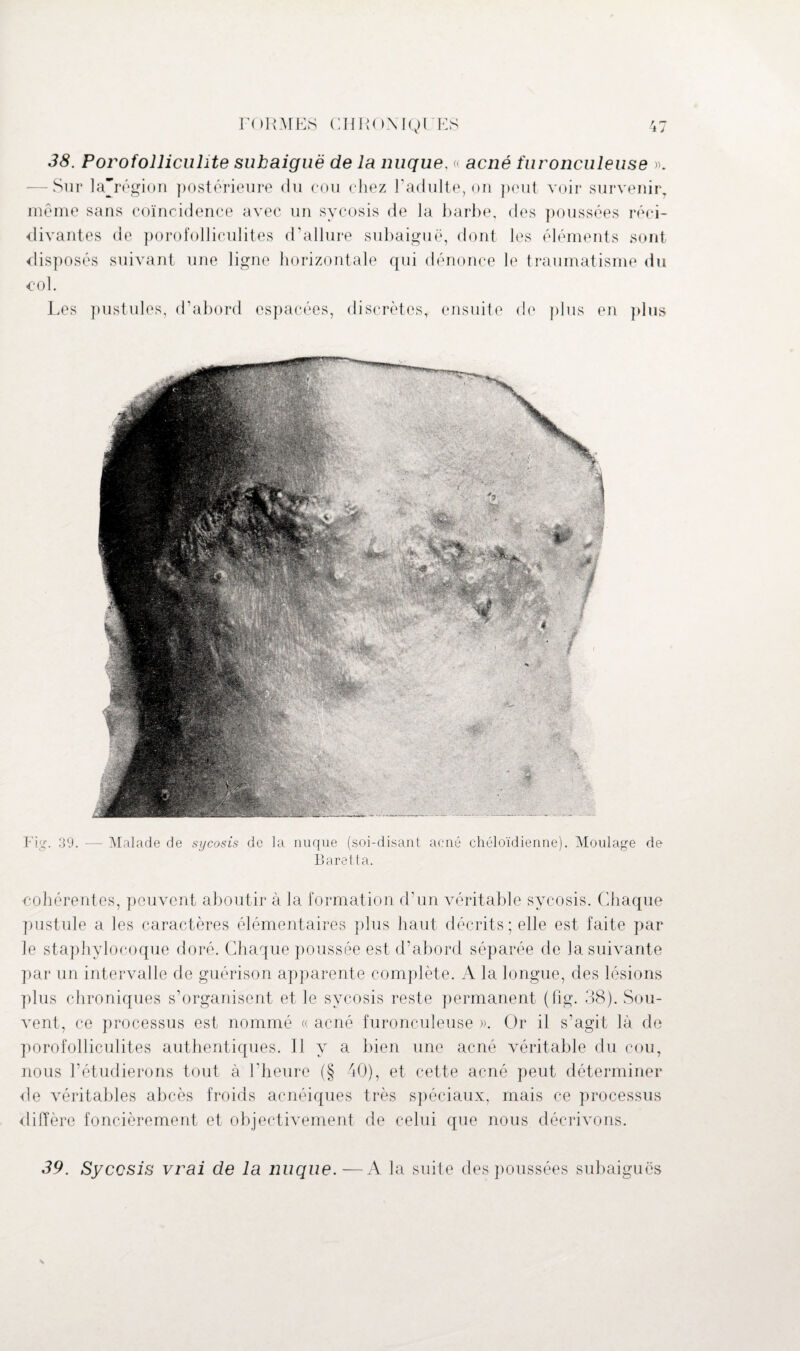 38. Porofolliculite subaiguë de la nuque, « acné furonculeuse ». -Sur la’région postérieure du cou chez l'adulte, on peut voir survenir, même sans coïncidence avec un sycosis de la barbe, des poussées réci¬ divantes de porofolliculites d’allure subaiguë, dont les éléments sont disposés suivant une ligne horizontale qui dénonce le traumatisme du col. Les pustules, d’abord espacées, discrètes, ensuite de plus en plus Fig. 39. -— Malade de sycosis de la nuque (soi-disant acné chéloïdienne). Moulage de Baratta. cohérentes, peuvent aboutir à la formation d’un véritable sycosis. Chaque pustule a les caractères élémentaires plus haut décrits; elle est faite par le staphylocoque doré. Chaque poussée est d’abord séparée de la suivante par un intervalle de guérison apparente complète. A la longue, des lésions plus chroniques s’organisent et le sycosis reste permanent (fig. 38). Sou¬ vent, ce processus est nommé « acné furonculeuse ». Or il s’agit là de porofolliculites authentiques. Il y a bien une acné véritable du cou, nous l’étudierons tout à l'heure (§ 40), et cette acné peut déterminer de véritables abcès froids acnéiques très spéciaux, mais ce processus diffère foncièrement et objectivement de celui que nous décrivons. 39. Syccsis vrai de la nuque.—A la suite des poussées subaiguës