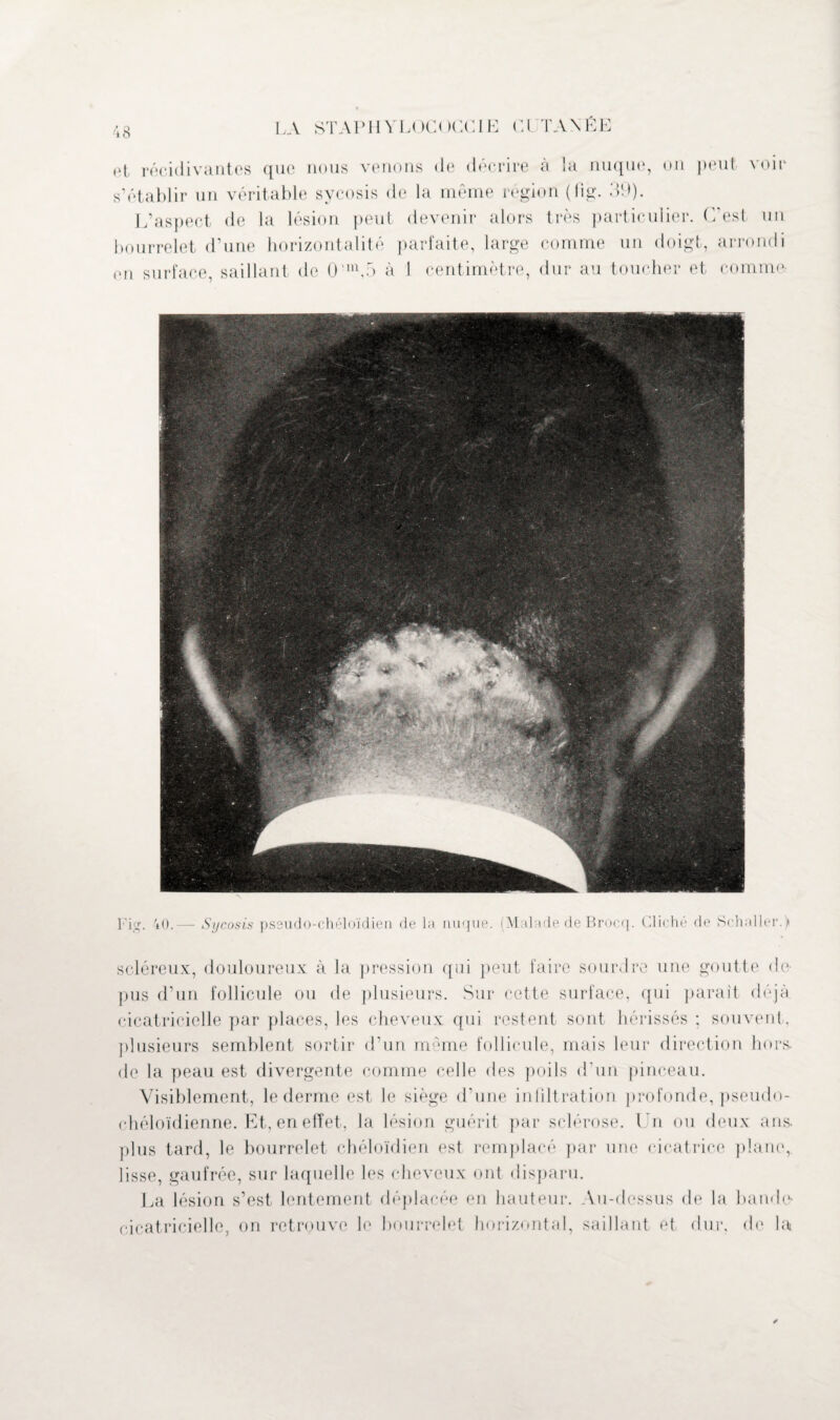 <>t récidivantes que nous venons de décrire à la nuque, on peut voir s’établir un véritable sycosis de la même région (fig. 39). L’aspect de la lésion peut bourrelet d’une horizontalité en surface, saillant de 0'n\5 à devenir alors très particulier. C’est un parfaite, large comme un doigt, arrondi 1 centimètre, dur au toucher et comme- Fig. 40.— Sycosis pssudo-chéloïdien de la nuque. (Malade de Brocq. Cliché de Schaller.) scléreux, douloureux à la pression qui peut faire sourdre une goutte de- pus d’un follicule ou de plusieurs. Sur cette surface, qui paraît déjà cicatricielle par places, les cheveux qui restent sont hérissés ; souvent, plusieurs semblent sortir d’un même follicule, mais leur direction hors, de la peau est divergente comme celle « les poils d'un pinceau. Visiblement, le derme est le siège d’une infiltration profonde, pseudo- chéloïdienne. Et, en effet, la lésion guérit par sclérose. Un ou deux ans. plus tard, le bourrelet chéloïdien est remplacé par une cicatrice plane, lisse, gaufrée, sur laquelle les cheveux ont disparu. La lésion s’est lentement déplacée en hauteur. Au-dessus de la bande- cicatricielle, on retrouve le bourrelet horizontal, saillant et dur, de la