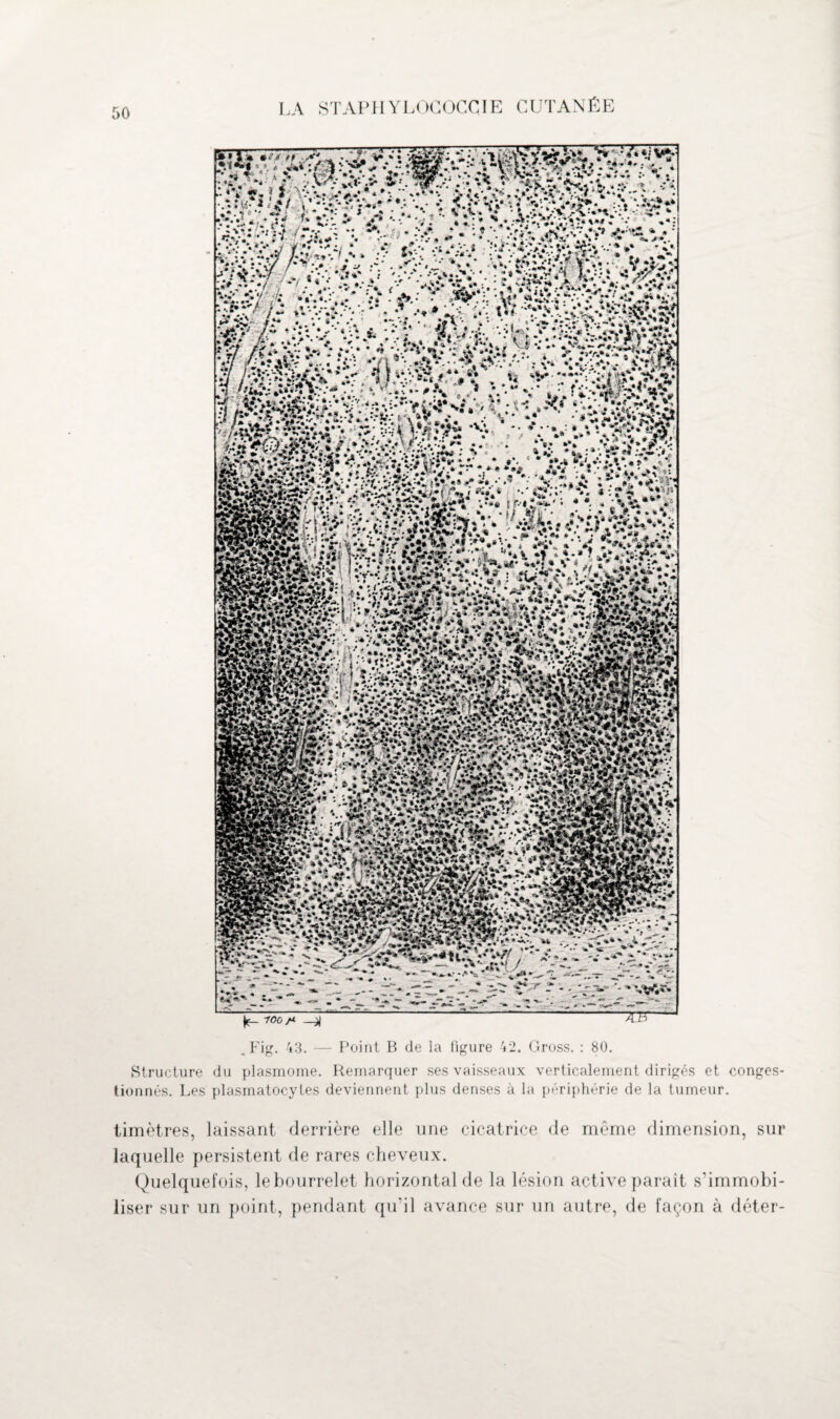 )ç_ rooyM .Fig. 43. — Point B de la figure 42. Gross. : 80. Structure du plasmome. Remarquer ses vaisseaux verticalement dirigés et conges¬ tionnés. Les plasmatocytes deviennent plus denses à la périphérie de la tumeur. timètres, laissant derrière elle une cicatrice de meme dimension, sur laquelle persistent de rares cheveux. Quelquefois, le bourrelet horizontal de la lésion active parait s’immobi¬ liser sur un point, pendant qu'il avance sur un autre, de façon à déter-