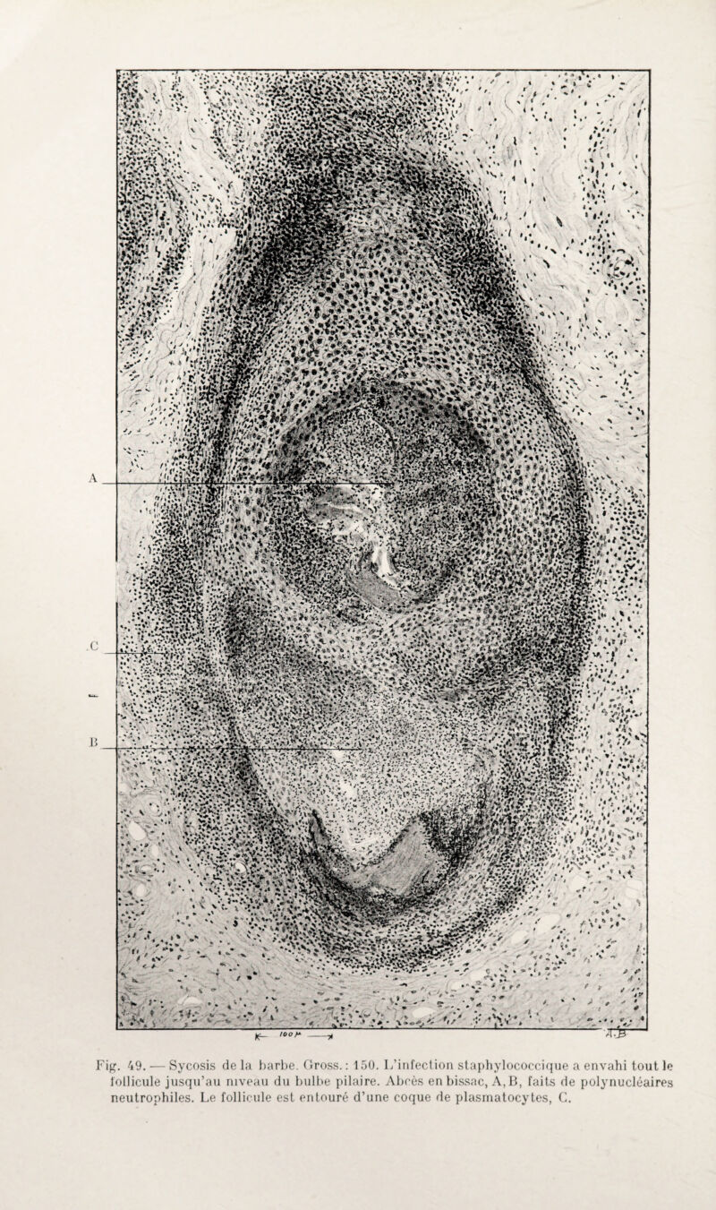 Fig. 49. — Sycosis delà barbe. Gross. : 150. L’infection staphylococcique a envahi tout le follicule jusqu’au niveau du bulbe pilaire. Abcès en bissac, A, B, faits de polynucléaires neutrophiles. Le follicule est entouré d’une coque de plasmatocytes, C.