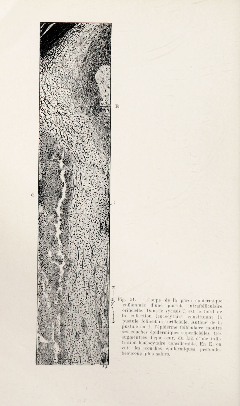 •'C ~ Coupe de la paroi épidermique enflammée d’une pustule intrafolliculaire orificielle. Dans le sycosis C est le bord de la collection leucocytaire constituant la pustule folliculaire orificielle. Autour de la pustule en I, 1 épiderme folliculaire montre ses couches épidermiques superficielles très augmentées d’épaisseur, du fait d’une infil¬ tration leucocytaire considérable. En E, on voit les couches épidermiques profondes beaucoup plus saines.