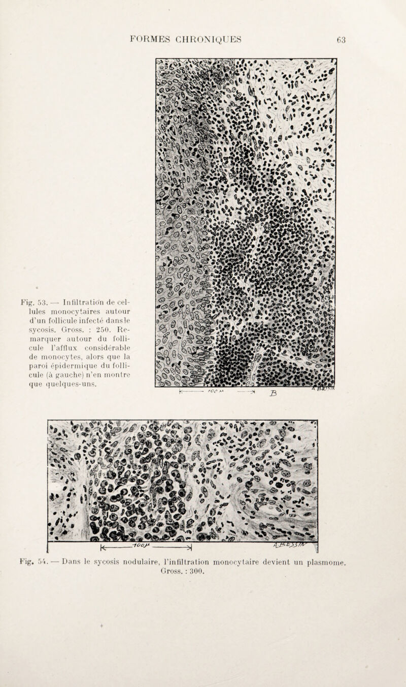 Fig. 53. — Infiltration de cel¬ lules monocytaires autour d’un follicule infecté dans le sycosis. Gross. : 250. Re¬ marquer autour du folli¬ cule l’afflux considérable de monocytes, alors que la paroi épidermique du folli¬ cule (à gauche) n’en montre que quelques-uns. »! (U •' N . - _• à Fig. 54. — Dans le sycosis nodulaire, l’infiltration monocytaire devient un plasmome. Gross. : 300.