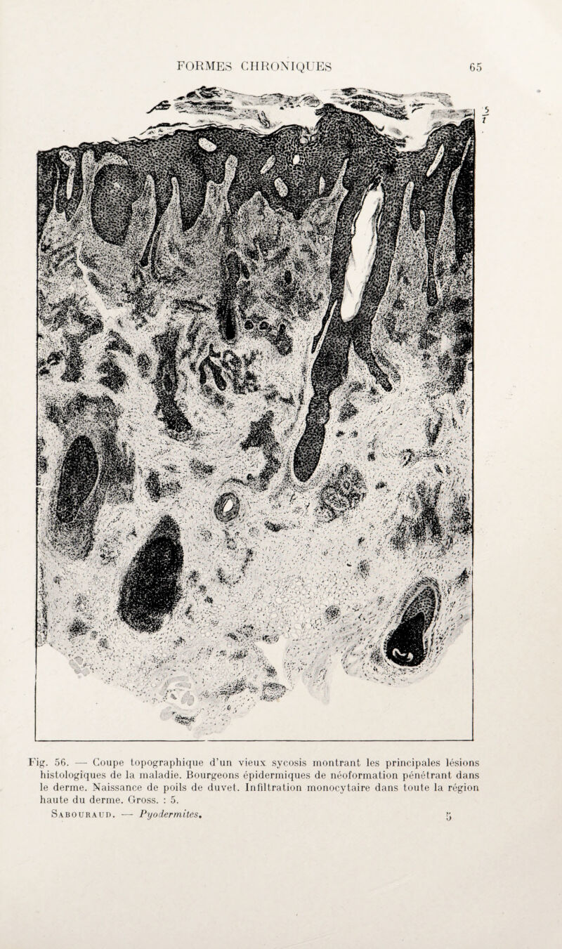 Fig. 56. — Coupe topographique d’un vieux sycosis montrant les principales lésions histologiques de la maladie. Bourgeons épidermiques de néoformation pénétrant dans le derme. Naissance de poils de duvet. Infdtration monocytaire dans toute la région haute du derme. Gross. : 5. Sabouraud. — Pyodermitcs, 5