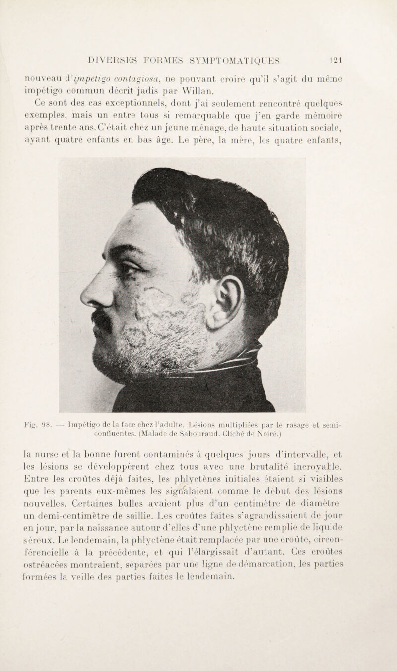 nouveau d’impétigo contagiosa, ne pouvant croire qu’il s’agit du même impétigo commun décrit jadis par Willan. Ce sont des cas exceptionnels, dont j’ai seulement rencontré quelques exemples, mais un entre tous si remarquable que j’en garde mémoire après trente ans. C’était chez un jeune ménage, de haute situation sociale, ayant quatre enfants en bas âge. Le père, la mère, les quatre enfants, Fig. 98. —- Impétigo de la face chez l’adulte. Lésions multipliées par le rasage et semi- contluentes. (Malade de Sabouraud. Cliché de Noire.) la nurse et la bonne furent contaminés à quelques jours d’intervalle, et les lésions se développèrent chez tous avec une brutalité incroyable. Entre les croûtes déjà faites, les phlyctènes initiales étaient si visibles que les parents eux-mêmes les signalaient comme le début des lésions nouvelles. Certaines bulles avaient plus d’un centimètre de diamètre un demi-centimètre de saillie. Les croûtes faites s’agrandissaient de jour en jour, par la naissance autour d’elles d’une phlyctène remplie de liquide séreux. Le lendemain, la phlyctène était remplacée par une croûte, circon- férencielle à la précédente, et qui l’élargissait d’autant. Ces croûtes ostréacées montraient, séparées par une ligne de démarcation, les parties formées la veille des parties faites le lendemain.