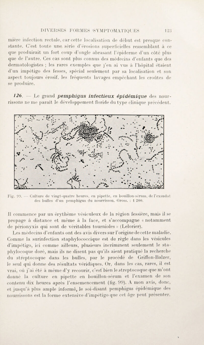 mière infection rectale, car cette localisation de début est presque con¬ stante. C'est toute une série, d'érosions superficielles ressemblant à ce que produirait un fort coup d'ongle abrasant l'épiderme d'un côté plus que de l’autre. Ces cas sont plus connus des médecins d’enfants que des dermatologistes ; les rares exemples que j’en ai vus à l’hôpital étaient d'un impétigo des fesses, spécial seulement par sa localisation et son aspect toujours érosif, les fréquents lavages empêchant les croûtes de se produire. 126. — Le grand pemphigus infectieux épidémique des nour¬ rissons ne me paraît le développement floride du type clinique précédent. Fig. 90. — Culture de vingt-quatre heures, en pipette, en bouillon-sérum, de l’exsudât des bulles d’un pemphigus du nourrisson. Gross. : 1 200. Il commence par un érythème vésiculeux de la région fessière, mais il se propage à distance et même à la face, et s'accompagne « notamment de périonyxis qui sont de véritables tournioles » (Lelorier). Les médecins d’enfants ont des avis divers sur l’origine de cette maladie. Comme la surinfection staphylococcique est de règle dans les vésicules d'impétigo, ici comme ailleurs, plusieurs incriminent seulement le sta¬ phylocoque doré, mais ils ne disent pas qu'ils aient pratiqué la recherche du streptocoque dans les bulles, par le procédé de Grifïon-Balzer, le seul qui donne des résultats véridiques. Or, dans les cas, rares, il est vrai, où j'ai été à même d’y recourir, c’est bien le streptocoque que m ont donné la culture en pipette en bouillon-sérum et l’examen de son contenu dix heures après l’ensemencement (fig. 99). A mon avis, donc, et jusqu'à plus ample informé, le soi-disant pemphigus épidémique des nourrissons est la forme extensive d’impétigo que cet ôge peut présenter. \