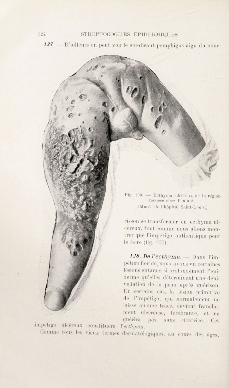 127. — D’ailleurs on peut voirie soi-disant pemphigus aigu du nour Fig-. 100. —• Ecthyma ulcéreux de la région fessière chez l’enfant. (Musée de l'hôpital Saint-Louis.) risson se transformer en ecthyma ul- céreux, tout comme nous allons mon¬ trer que l’impétigo authentique peut le faire (fîg. 100). 128. Del’ecthyma.— Dans l’im¬ pétigo floride, nous avons vu certaines lésions entamer si profondément l’épi¬ derme qu’elles déterminent une déni¬ vellation de la peau après guérison. En certains cas, la lésion primitive de l’impétigo, qui normalement ne laisse aucune trace, devient franche¬ ment ulcéreuse, térébrante, et ne guérira pas sans impétigo ulcéreux constituera Vecthyma. Comme tous les vieux termes dermatologiques, au cicatrice. Cet cours des âges,