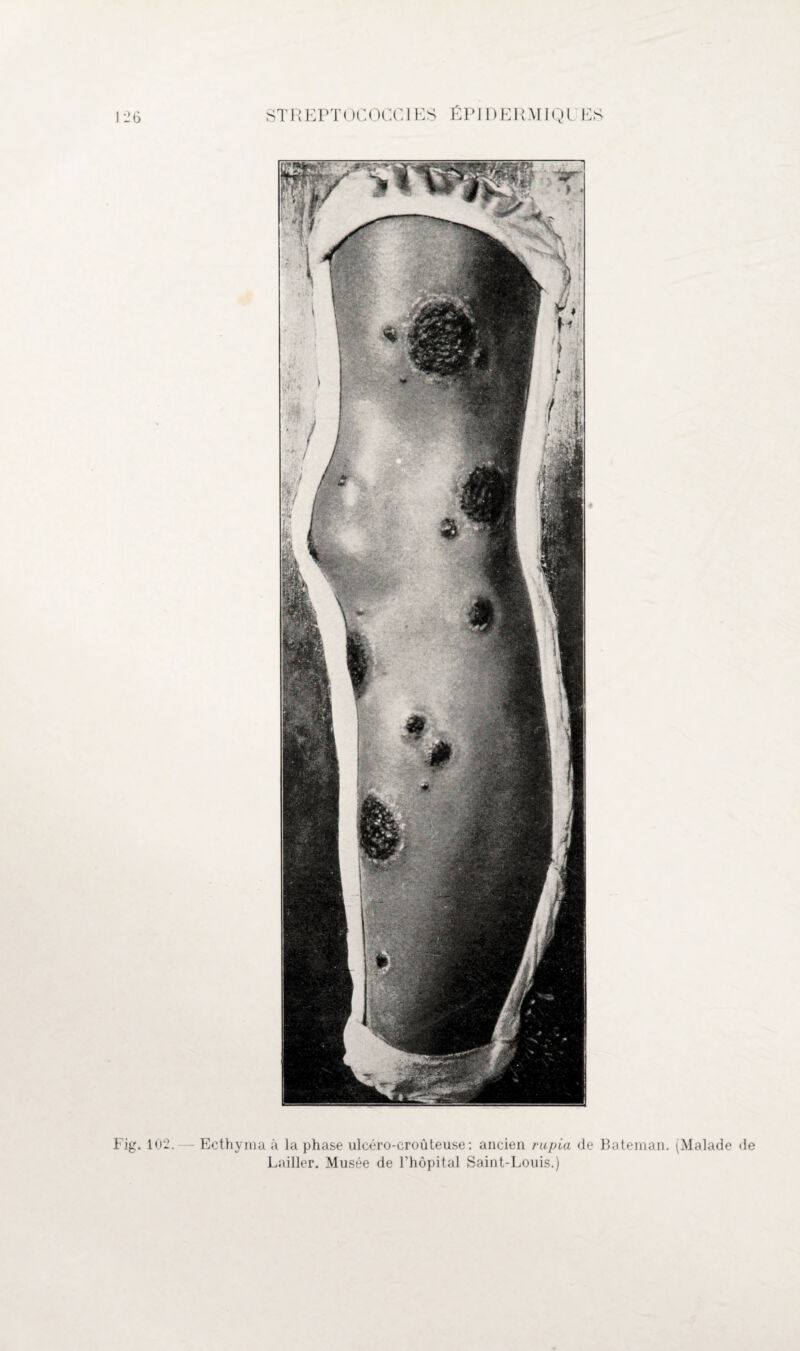 Fig. 102. — Ecthyma à la phase ulcéro-croûteuse : ancien rupia de Bateman. (Malade de Lailler. Musée de Fhôpital Saint-Louis.)