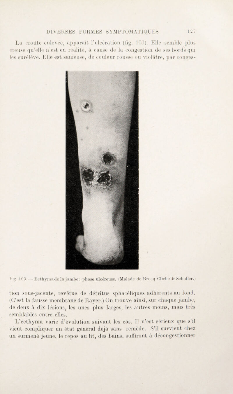 La croûte enlevée, appareil T ulcération (fig. 10. î ). Elle creuse qu'elle n'est en réalité, à cause de la congestion de les surélève. Elle est sanieuse, de couleur rousse ou violâtre semble plus ses bords qui , par conges- Fig. 103. — Ecthymade la jambe : phase ulcéreuse. (Malade de Brocq. Cliché de Schaller.) tion sous-jacente, revêtue de détritus sphacéliques adhérents au fond. (C'est la fausse membrane de Rayer.) On trouve ainsi, sur chaque jambe, de deux à dix lésions, les unes plus larges, les autres moins, mais très semblables entre elles. L'ecthyma varie d’évolution suivant les cas. 11 n'est sérieux que s il vient compliquer un état général déjà sans remède. S’il survient chez un surmené jeune, le repos au lit, des bains, suffiront à décongestionner