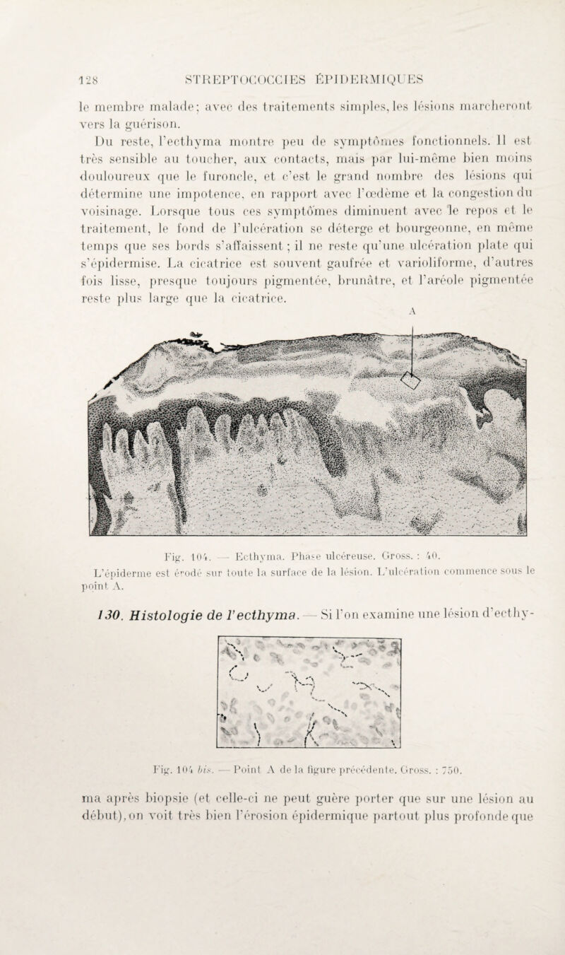 le membre malade; avec des traitements simples,les lésions marcheront vers la guérison. Du reste, Pecthyma montre peu de symptômes fonctionnels. 11 est très sensible au toucher, aux contacts, mais par lui-même bien moins douloureux que le furoncle, et c’est le grand nombre des lésions qui détermine une impotence, en rapport avec l’oedème et la congestion du voisinage. Lorsque tous ces symptômes diminuent avec le repos et le traitement, le fond de l’ulcération se déterge et bourgeonne, en même temps que ses bords s’affaissent ; il ne reste qu’une ulcération plate qui s’épidermise. La cicatrice est souvent gaufrée et varioliforme, d’autres fois lisse, presque toujours pigmentée, brunâtre, et l’aréole pigmentée reste plus large que la cicatrice. A Fig. 104. — Ecthyma. Phase ulcéreuse. Gross. : 40. L’épiderme est érodé sur toute la surface de la lésion. L ulcération commence sous le point A. 130. Histologie de ïecthyma. — Si l’on examine une lésion d’ecthy- Fig. 104 bis. — Point A de la figure précédente. Gross. : 750. ma après biopsie (et celle-ci ne peut guère porter que sur une lésion au début), on voit très bien P érosion épidermique partout plus profonde que