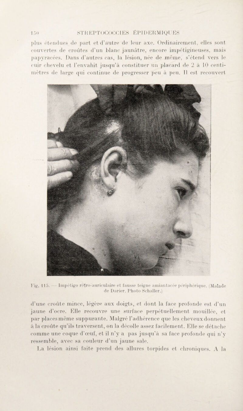 ])lus ('‘tendues de part et d'autre rie leur axe. Ordinairement, elles sont couvertes de croûtes d’un blanc jaunâtre, encore impétigineuses, mais papyracées. Dans d’autres cas, la lésion, née de même, s’étend vers le cuir chevelu et l’envahit jusqu’à constituer un placard de 2 à 10 centi¬ mètres de large qui continue de progresser peu à peu. Il est recouvert Fig. 115. — Impétigo rétro-auriculaire et fausse teigne amiantacée périphérique. (Malade de Darier. Photo Schaller.) d’une croûte mince, légère aux doigts, et dont la face profonde est d’un jaune d’ocre. Elle recouvre une surface perpétuellement mouillée, et par places même suppurante. Malgré l’adhérence que les cheveux donnent à la croûte qu’ils traversent, on la décolle assez facilement. Elle se dét ache comme une coque d’œuf, et il n’y a pas jusqu’à sa face profonde qui n'y ressemble, avec sa couleur d’un jaune sale. La lésion ainsi faite prend des allures torpides et chroniques. A la