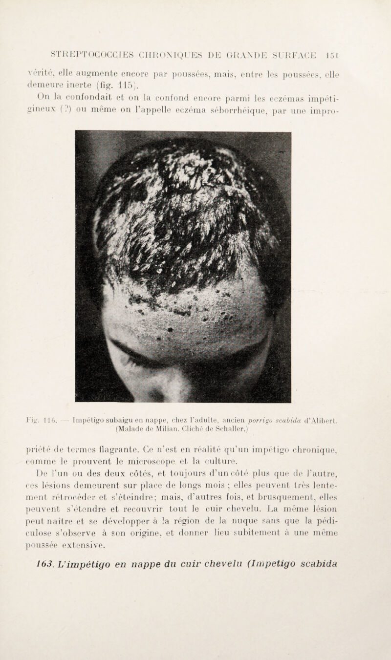 vérité, elle augmente encore par poussées, mais, entre I demeure inerte (flg. 115). ( )n la confondait et on la conlond encore parmi les gineux (.') ou môme on l'appelle eczéma séborrhéique, es poussées, elle eczémas impôt i- par une impro- Fig. 116. — Impétigo subaigu en nappe, chez l’adulte, ancien porrigo scabida d’Alibert. (Malade de Milian. Cliché de Schaller.) priété de termes flagrante. Ce n’est en réalité qu’un impétigo chronique, comme le prouvent le microscope et la culture. De l’un ou des deux côtés, et toujours d’un côté plus que de l'autre, ces lésions demeurent sur place de longs mois ; elles peuvent très lente¬ ment rétrocéder et s’éteindre; mais, d’autres fois, et brusquement, elles peuvent s’étendre et recouvrir tout le cuir chevelu. La même lésion peut naître et se développer à la région de la nuque sans que la pédi- culose s’observe à son origine, et donner lieu subitement à une même poussée extensive. 163. L’impétigo en nappe du cuir chevelu (Impétigo scabida