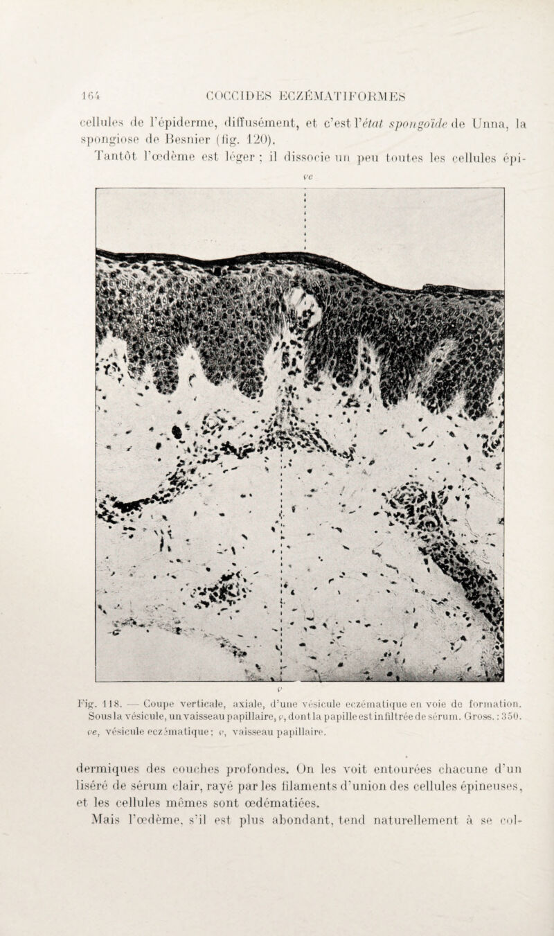 cellules de l’épiderme, diffusément, et c’est Vétat spongoïde de Unna, la spongiose de Besnier (lig. 120). 1 antôt l’œdème est léger; il dissocie un peu toutes les cellules épi¬ ce c Fig. 118. — Coupe verticale, axiale, d’une vésicule eczématique en voie de formation. Sous la vésicule, un vaisseau papillaire, c, dont la papille est infiltrée de sérum. Gross. : 350. ce, vésicule eczématique: c, vaisseau papillaire. dermiques des couches profondes. On les voit entourées chacune d’un liséré de sérum clair, rayé parles filaments d’union des cellules épineuses, et les cellules mêmes sont œdématiées. Mais l’œdème, s’il est plus abondant, tend naturellement à se col-