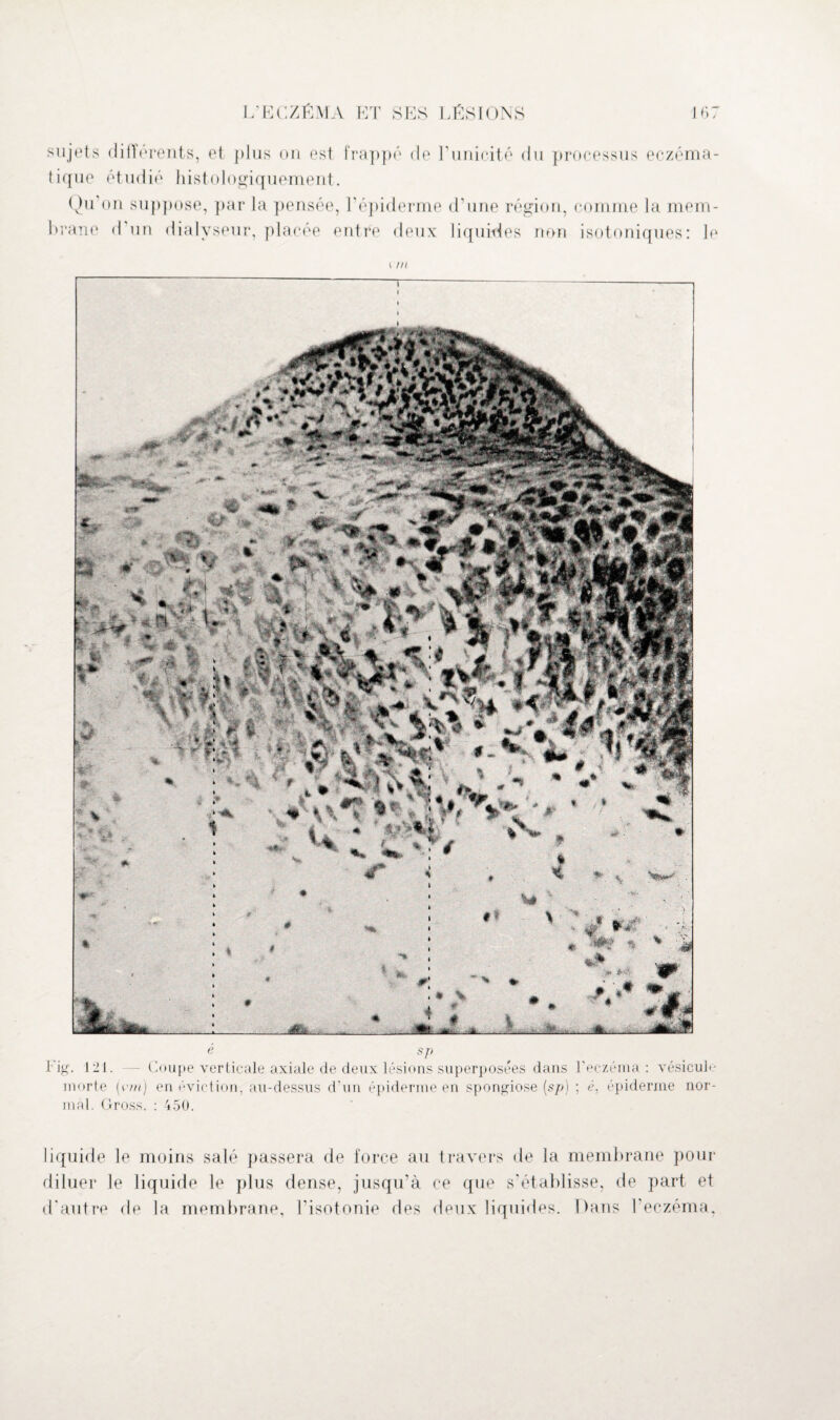 sujets différents, et plus on est frappé de l'unicité du processus eczéma- tique étudié histologiquement. Qu on suppose, par la pensée, l’épiderme d’une région, comme la mem¬ brane d un dialvseur, placée entre deux liquides non isotoniques: le i m e sp Fig. 121. — Coupe verticale axiale de deux lésions superposées dans l'eczéma : vésicul*- morte (cm) en éviction, au-dessus d'un épiderme en spongiose (sp) ; é, épiderme nor¬ mal. Gross. : 450. liquide le moins salé passera de force au travers de la membrane pour diluer le liquide le plus dense, jusqu'à ce que s'établisse, de part et d'autre de la membrane, l'isotonie des deux liquides. Dans l’eczéma,