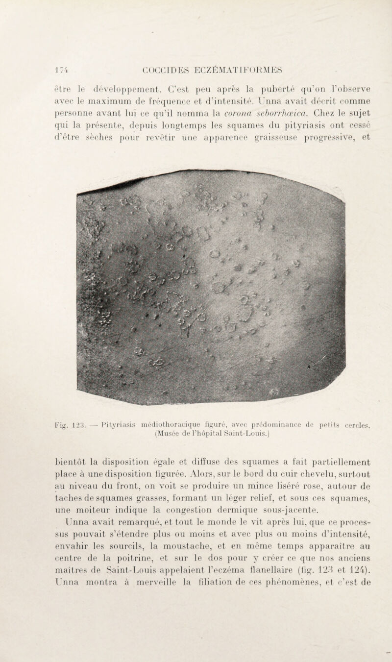 être le développement. C’est peu après la puberté qu’on l’observe avec le maximum de fréquence et d’intensité. Unna avait décrit comme personne avant lui ce qu’il nomma la corona seborrhœica. Chez le sujet qui la présente, depuis longtemps les squames du pityriasis ont cessé d’être sèches pour revêtir une apparence graisseuse progressive, et Fig. 123. —Pityriasis médiothoracique figuré, avec prédominance de petits cercles. (Musée de l’hôpital Saint-Louis.) bientôt la disposition égale et diffuse des squames a fait partiellement place à une disposition figurée. Alors, sur le bord du cuir chevelu, surtout au niveau du front, on voit se produire un mince liséré rose, autour de taches de squames grasses, formant un léger relief, et sous ces squames, une moiteur indique la congestion dermique sous-jacente. Unna avait remarqué, et tout le monde le vit après lui, que ce proces¬ sus pouvait s’étendre plus ou moins et avec plus ou moins d’intensité, envahir les sourcils, la moustache, et en même temps apparaître au centre de la poitrine, et sur le dos pour y créer ce que nos anciens maîtres de Saint-Louis appelaient l’eczéma flanellaire (fig. 123 et 124). Unna montra à merveille la filiation de ces phénomènes, et c'est de